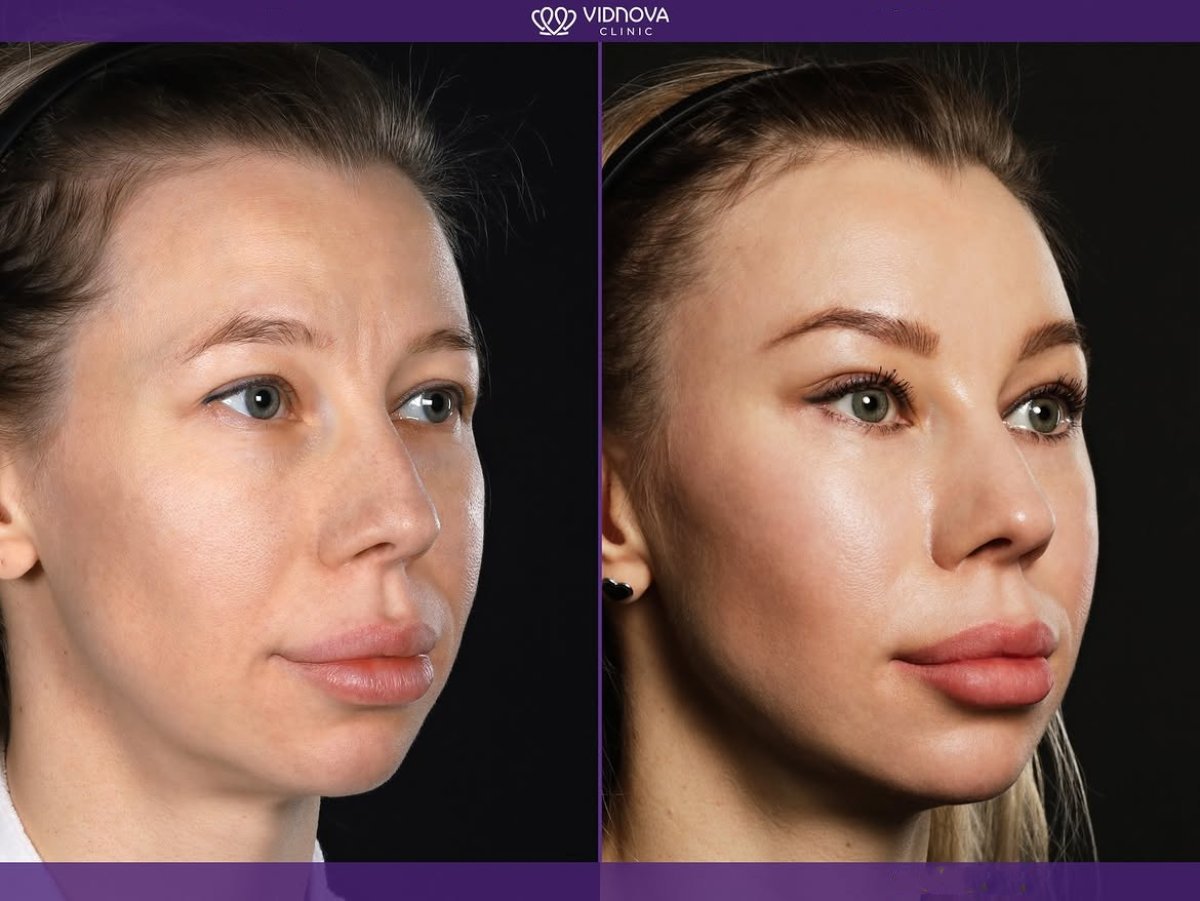Resultado antes y después de lifting facial deep plane en Vidnova Clinic, rejuvenecimiento visible