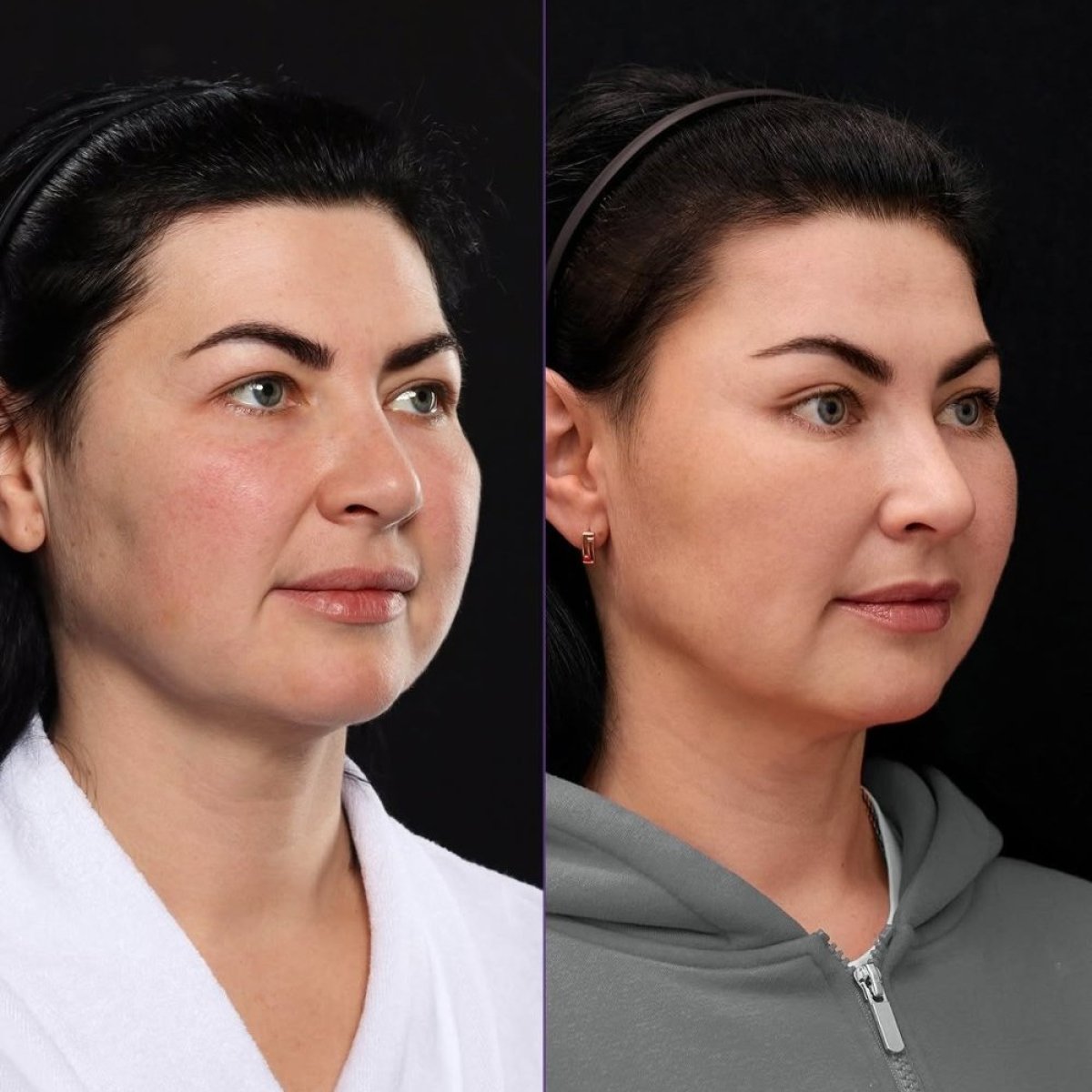 Результати до і після Deep Plane Facelift у клініці Vidnova – помітне омолодження обличчя