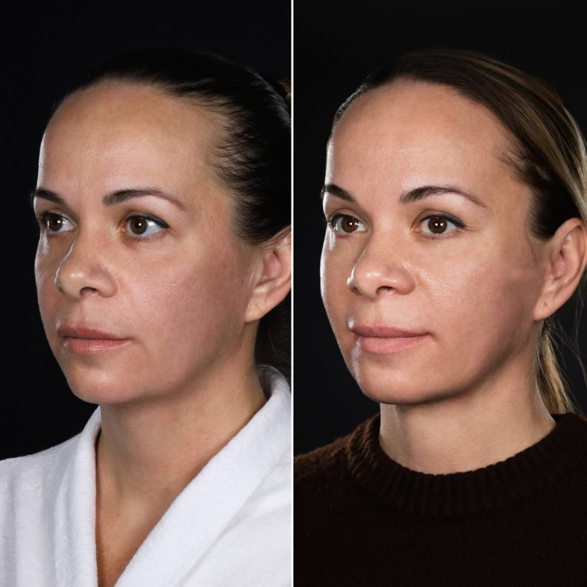 Before and after Deep Plane Facelift results at Vidnova Clinic, visible facial rejuvenation