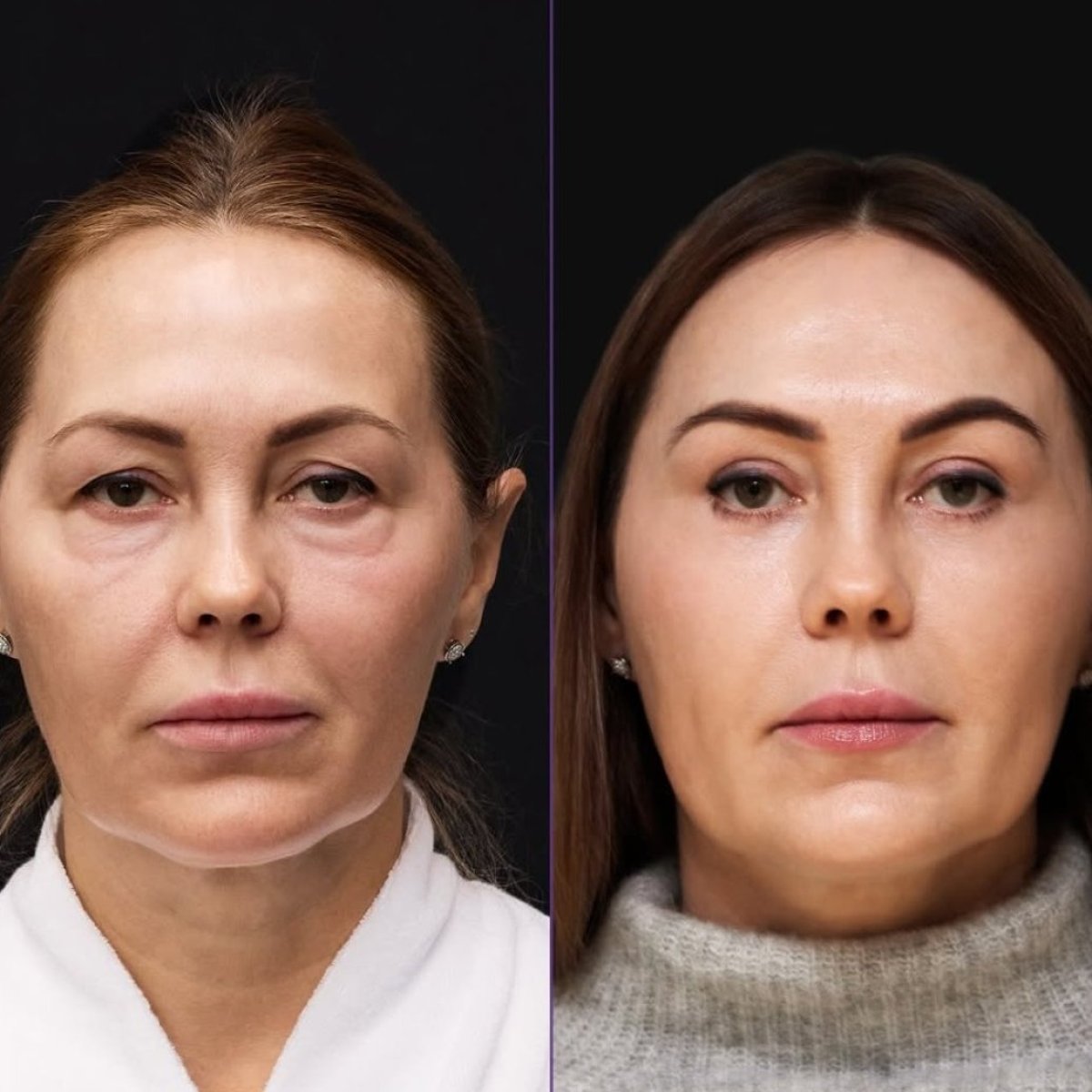 Résultats avant/après lifting deep plane à la Vidnova Clinic – rajeunissement du visage