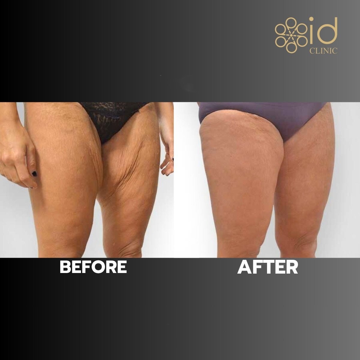 Before and after liposuction results at ID Clinic Bangkok, thigh contour improvement visible