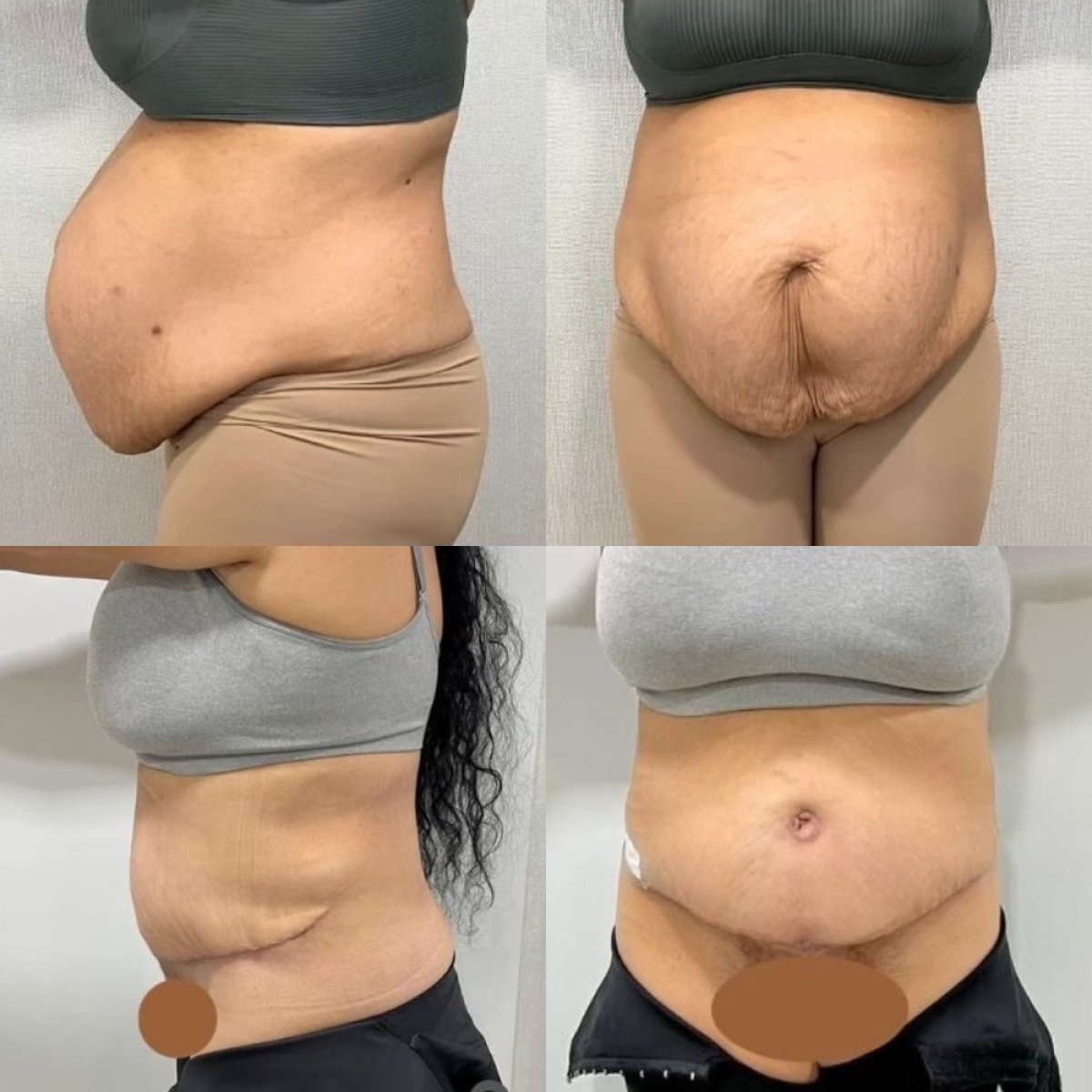 Before and after liposuction results at ID Clinic Bangkok, visible abdominal contour improvement