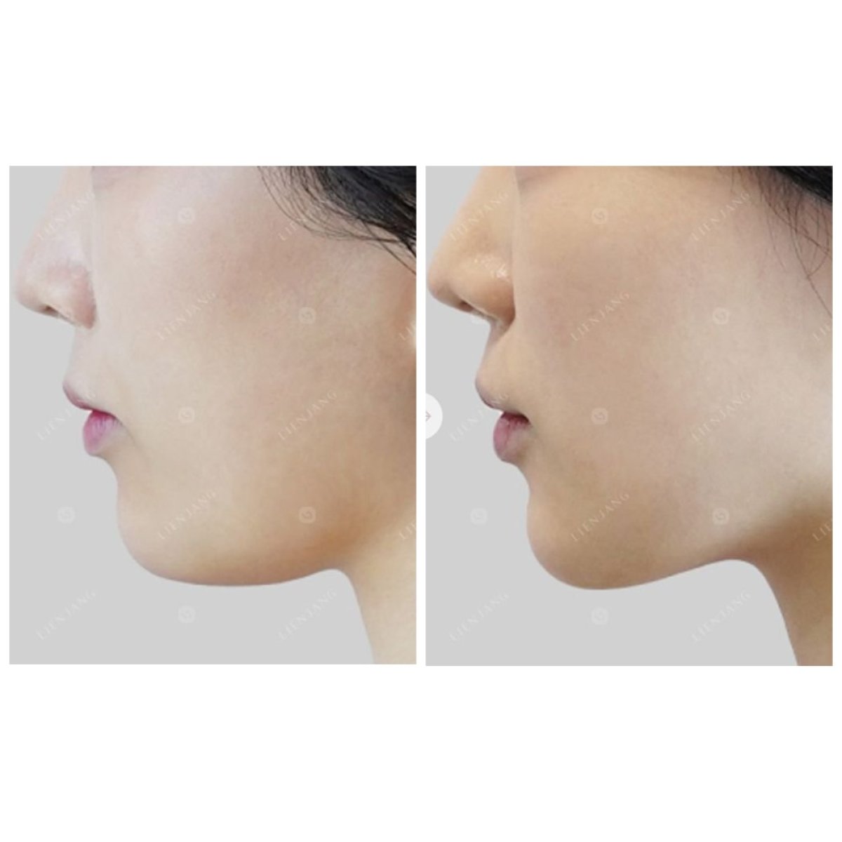 Ultherapy before and after results – visible jawline lift and skin tightening effect