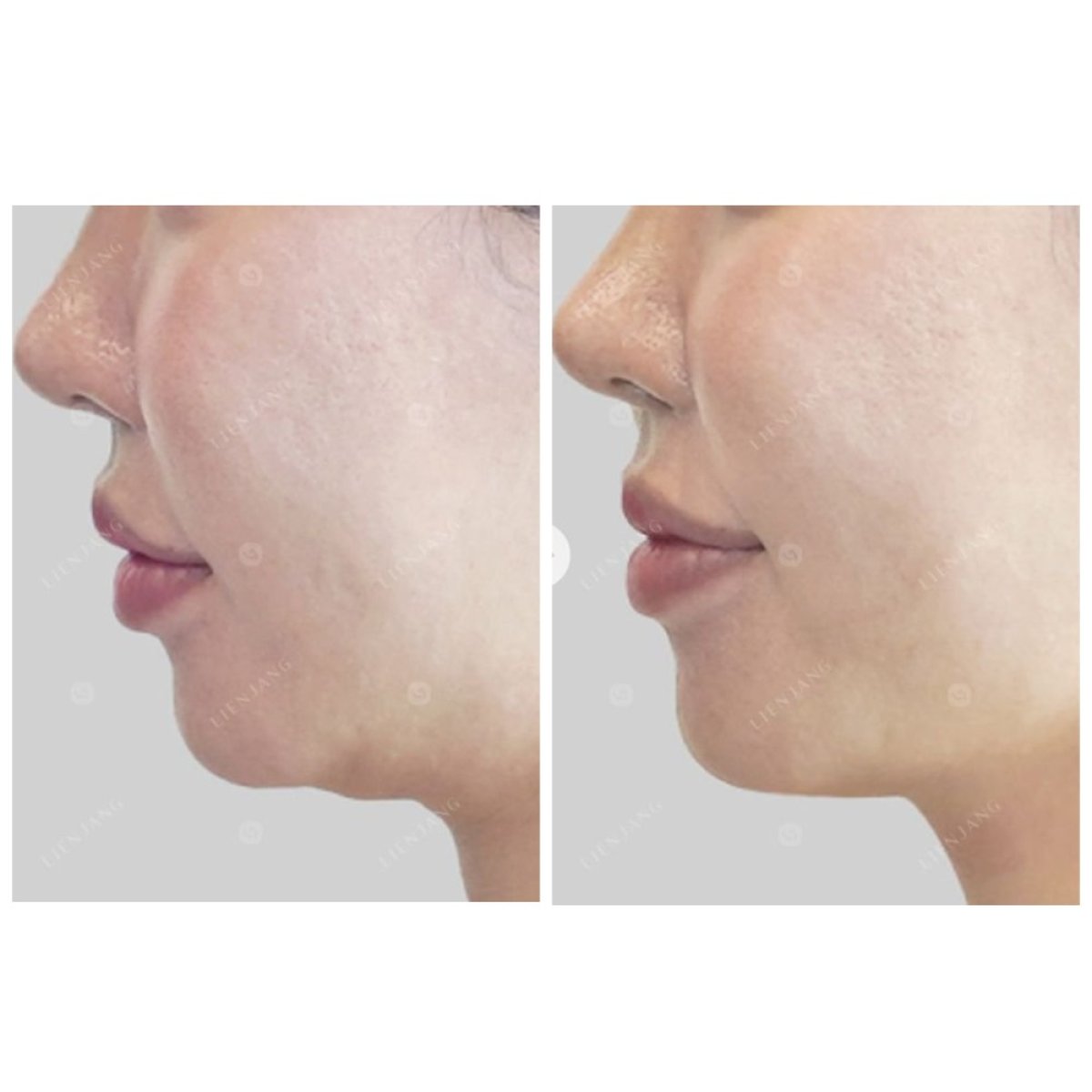 Résultats avant/après Ultherapy – amélioration visible du galbe du menton et de la mâchoire