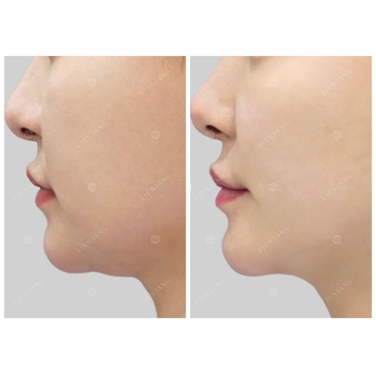 Ultherapy before and after results – visible jawline lift and skin tightening improvement