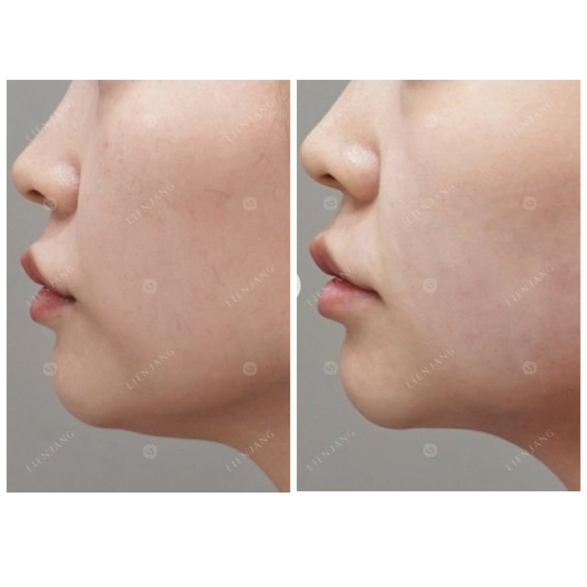 Before and after Ultherapy results at Lienjang Clinic – visible jawline and chin lift