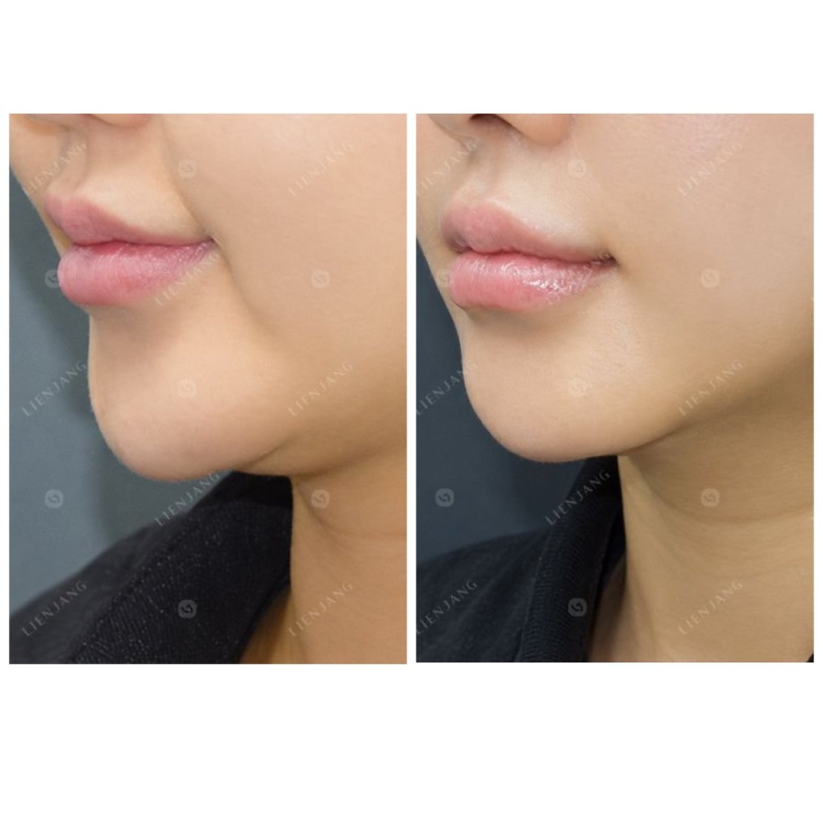 Результаты до и после Ultherapy в клинике Lienjang – улучшение контура подбородка