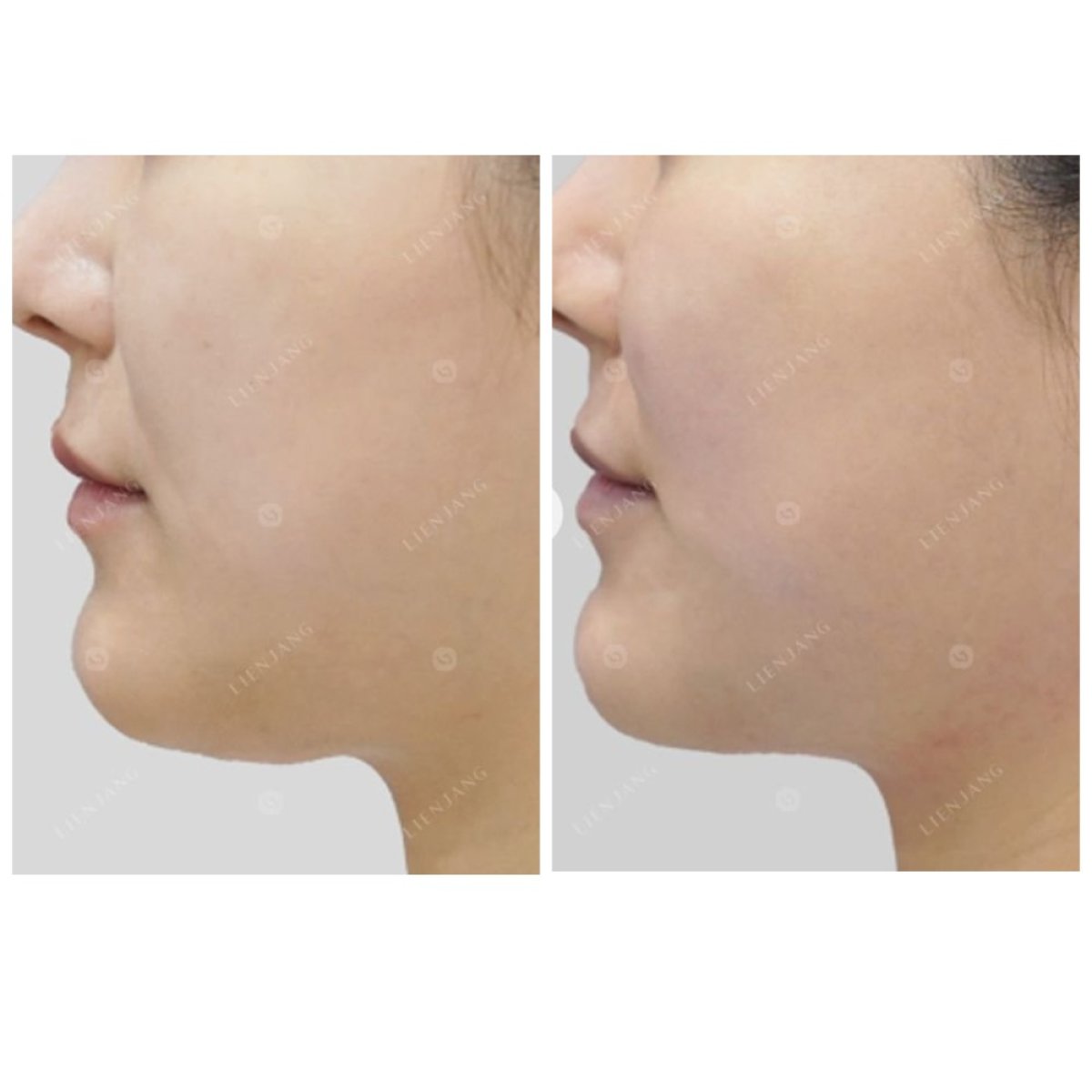 Before and after Thermage results at Lienjang Clinic – visible jawline tightening effect