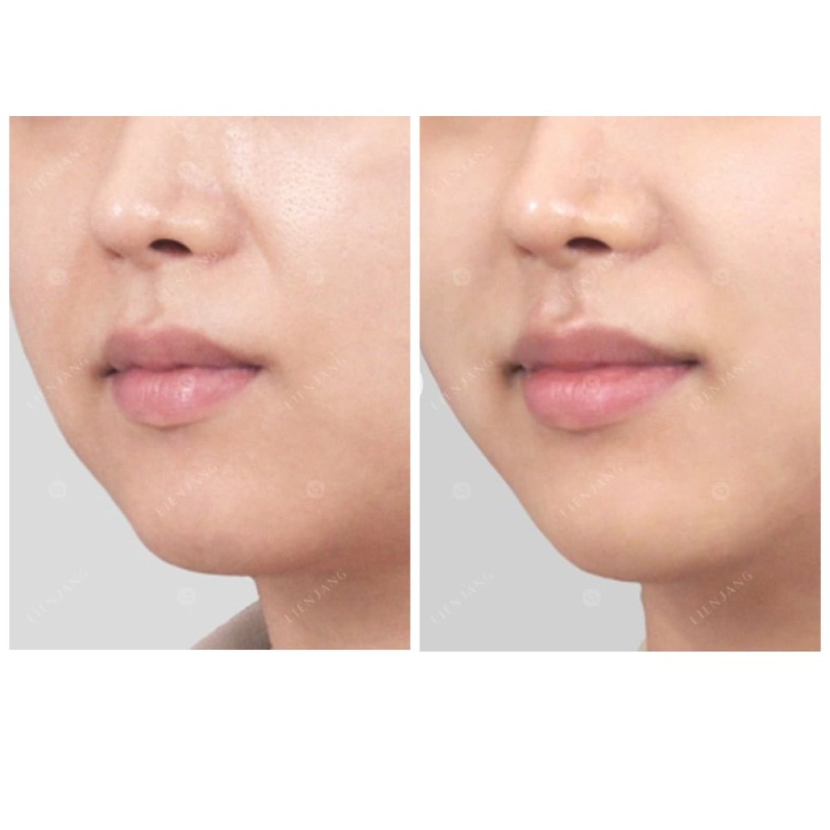 Before and after Thermage results – improved skin tightness and contour around jawline