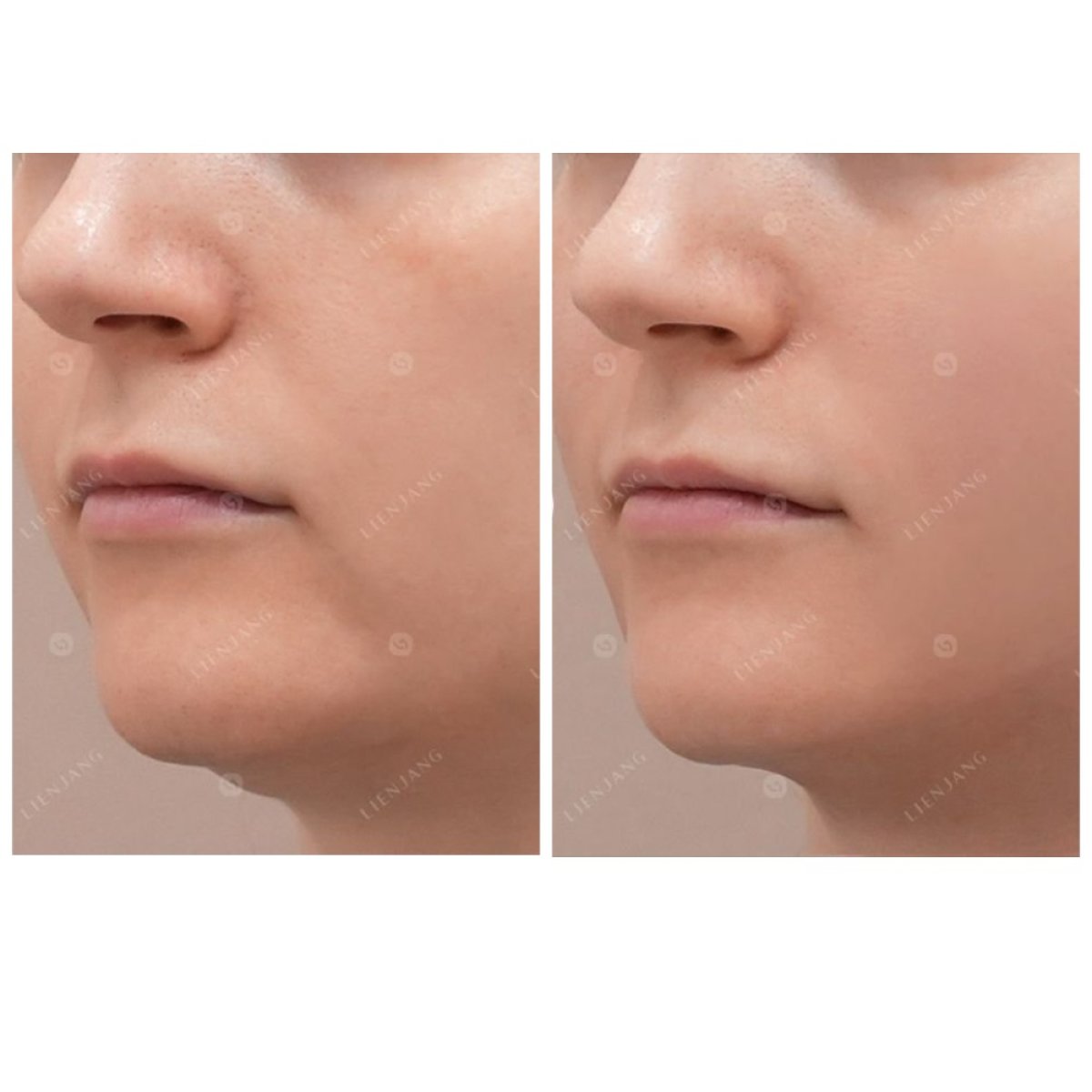 Before and after Thermage results at clinic – improved skin tightness and facial contour