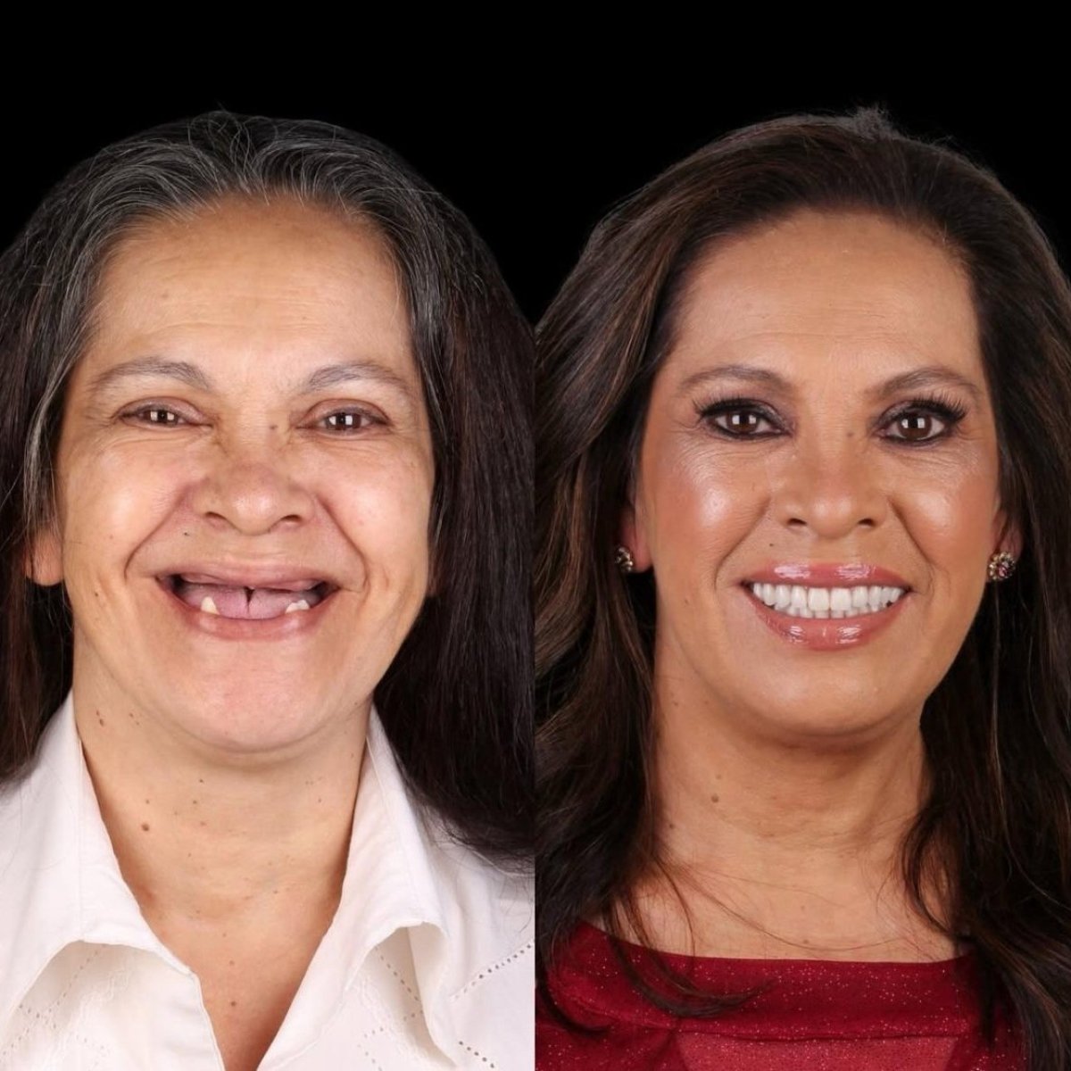 Результати до і після імплантації зубів у Dt. Sibel Gökçeer Dental Clinic, відновлена посмішка