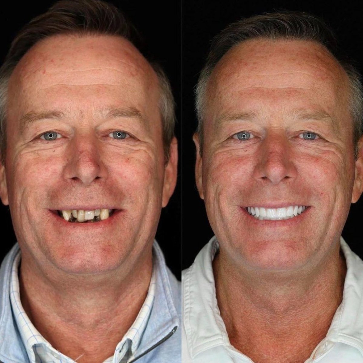 Before and after dental implant results at Dt. Sibel Gökçeer Dental Clinic, restored smile