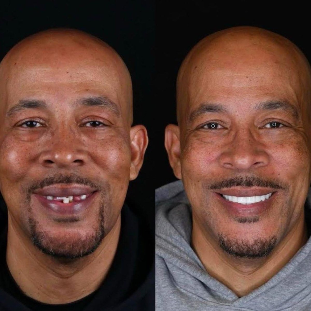 Before and after dental implant results at Dt. Sibel Gökçeer Dental Clinic, restored smile