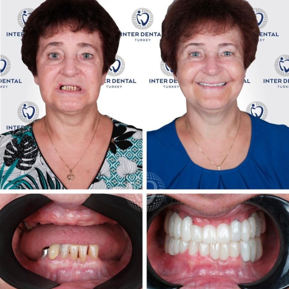 Resultados de implantes dentales antes y después en Inter Dental Turkey, sonrisa restaurada