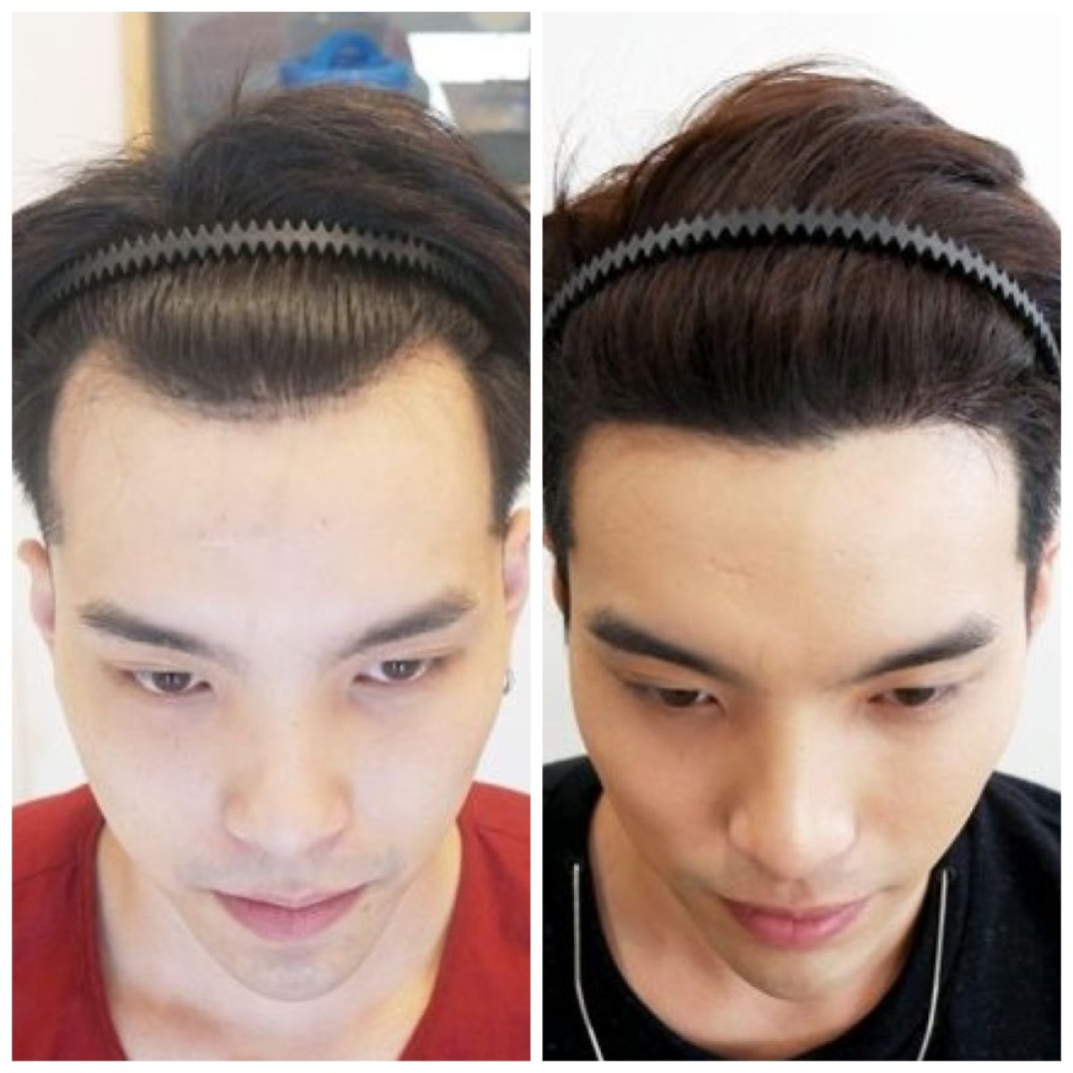 نتيجة زراعة الشعر FUE قبل وبعد في Dr.Orn Clinic : Medical Hair، خط شعر محسّن