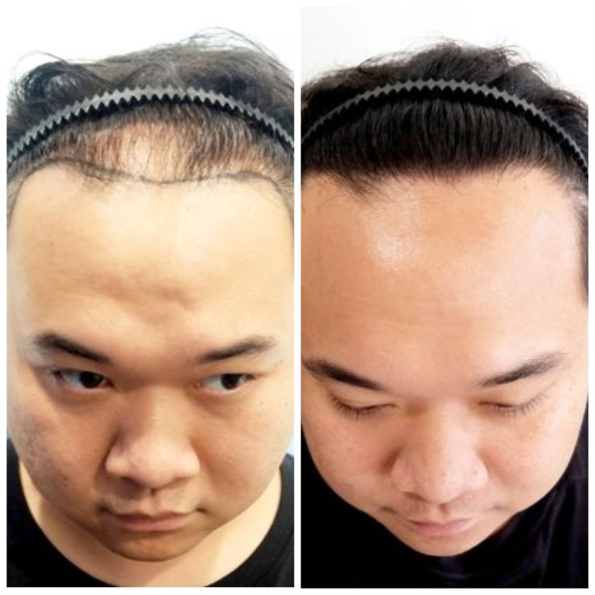 Vorher-nachher-Ergebnis FUE-Haartransplantation bei Dr.Orn Clinic : Medical Hair, verbesserter Haaransatz