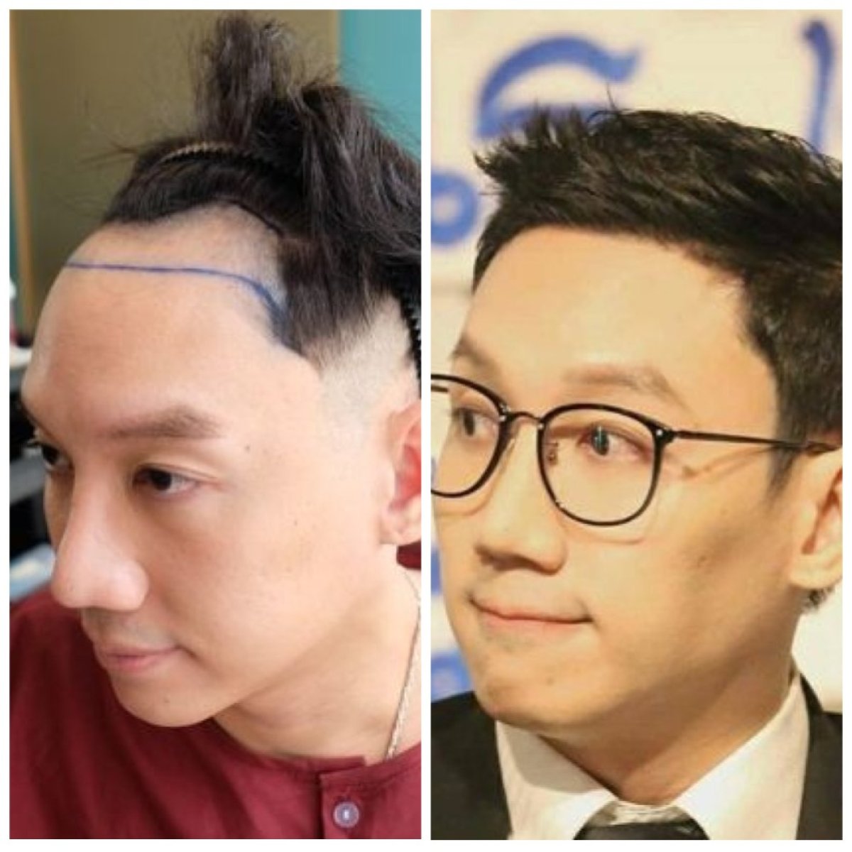 Vorher-nachher-Ergebnis FUE-Haartransplantation bei Dr.Orn Clinic : Medical Hair, verbesserter Haaransatz