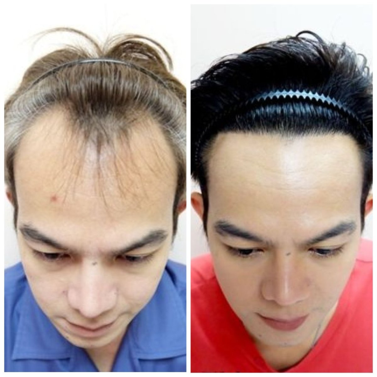 Before and after FUE hair transplant results at Dr.Orn Clinic : Medical Hair, restored hairline