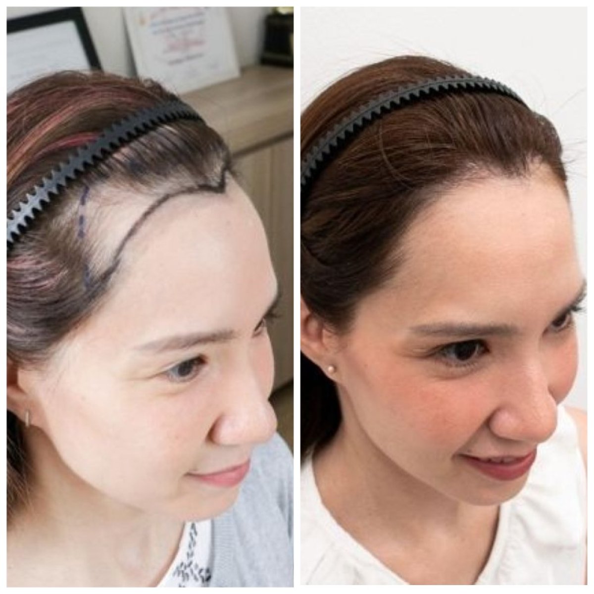 Результат до і після пересадки волосся FUE у Dr.Orn Clinic : Medical Hair, покращена лінія волосся