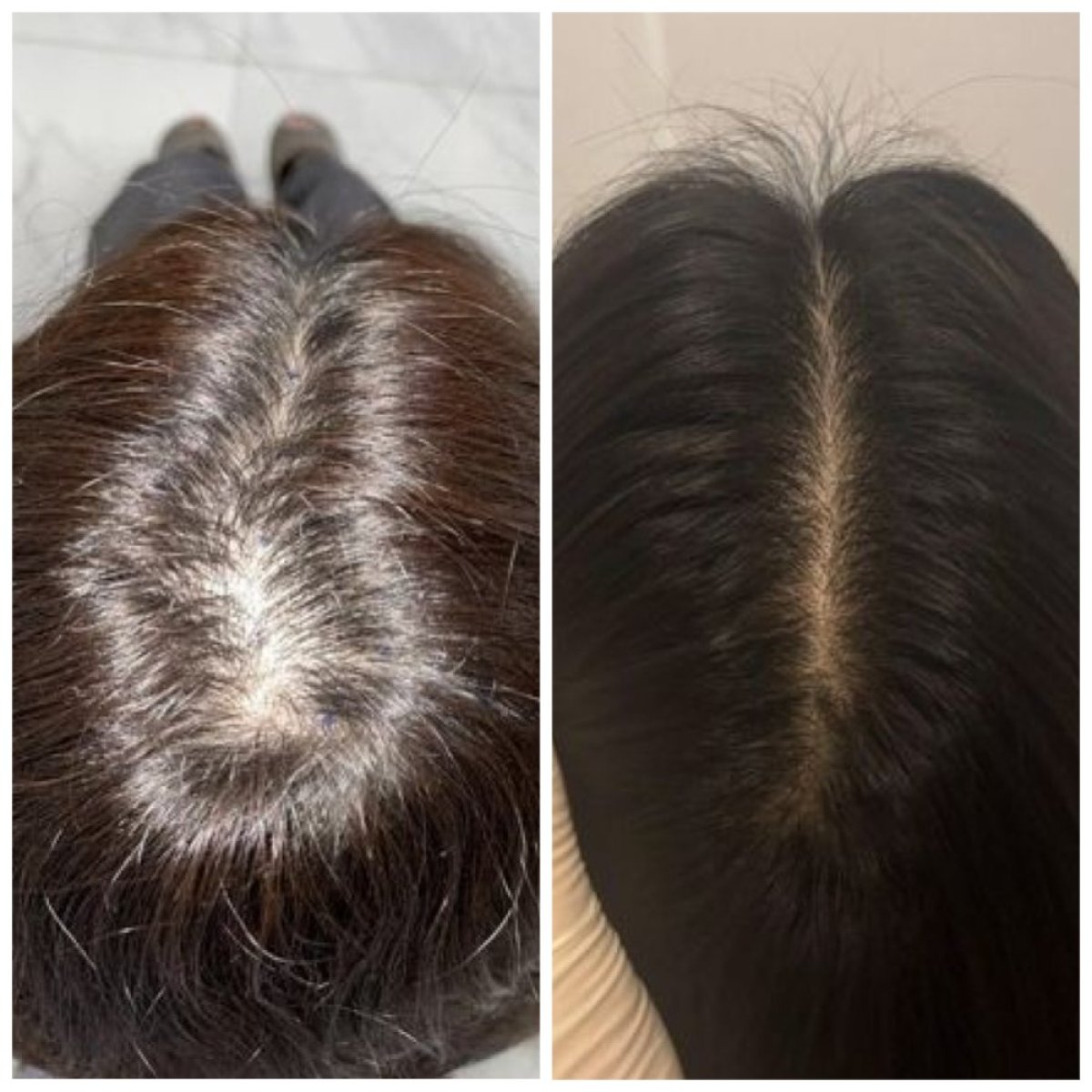 نتائج زراعة الشعر FUE قبل وبعد في Dr.Orn Clinic : Medical Hair، كثافة شعر محسنة