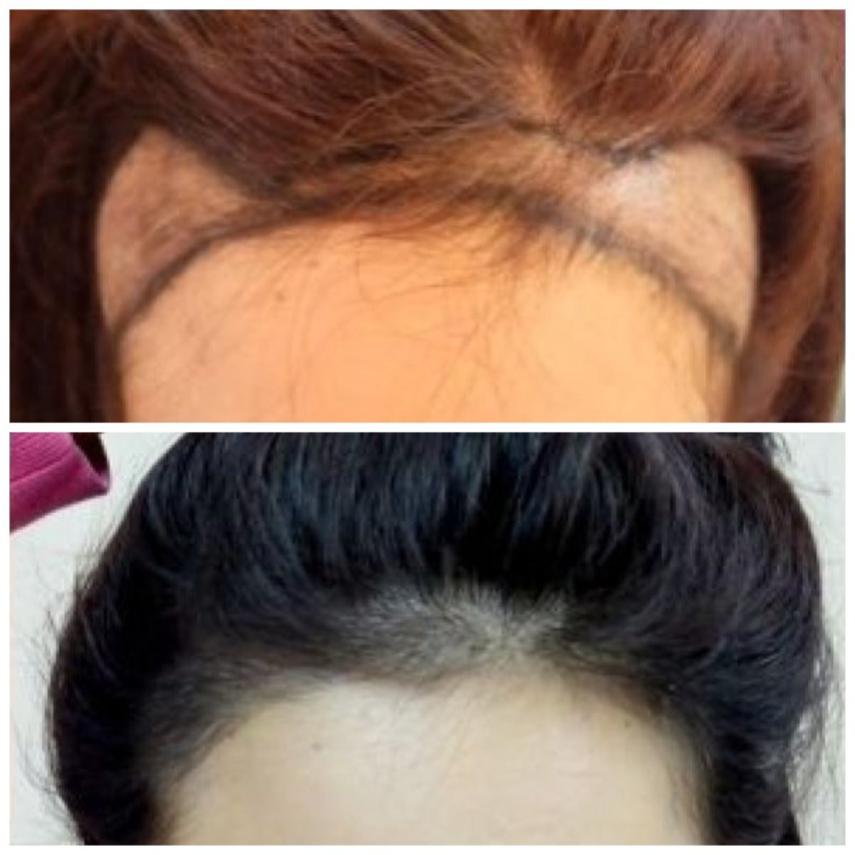 نتيجة زراعة الشعر FUE قبل وبعد في Dr.Orn Clinic : Medical Hair، خط شعر محسن