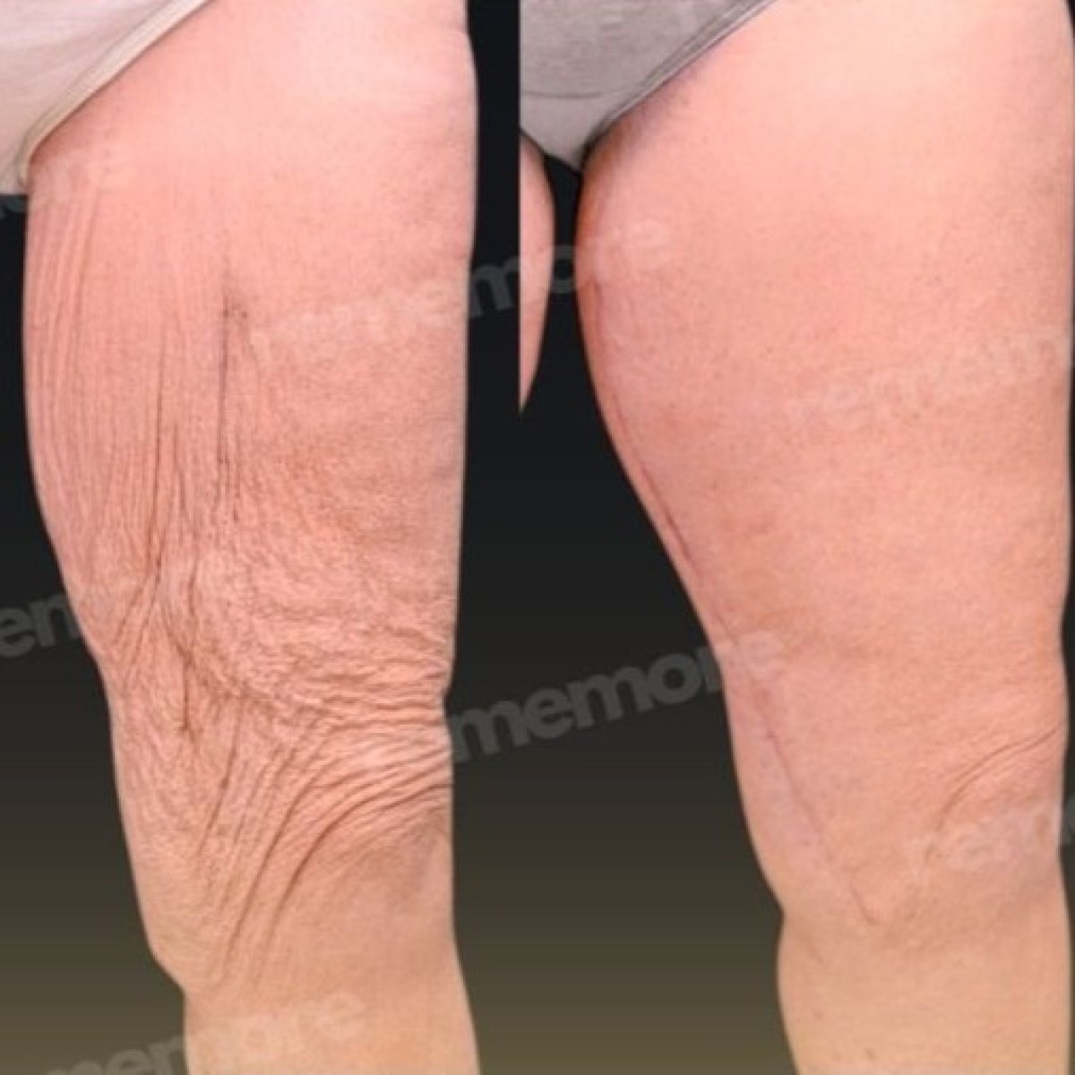Before and after thigh lift results at Memorial Bahçelievler Hospital, smoother thigh contour
