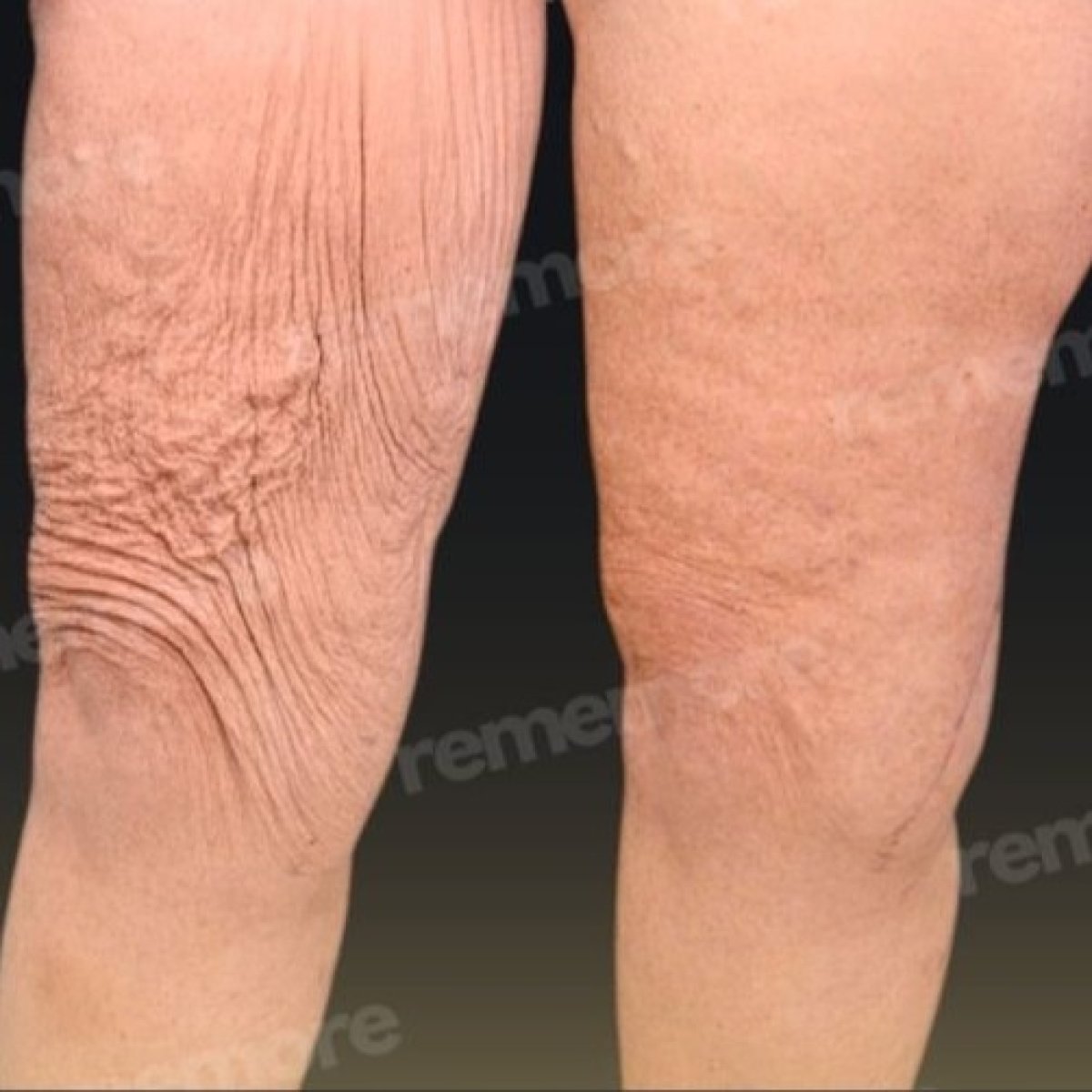 Resultados de lifting de muslos antes y después en Memorial Bahçelievler Hospital, muslo más liso
