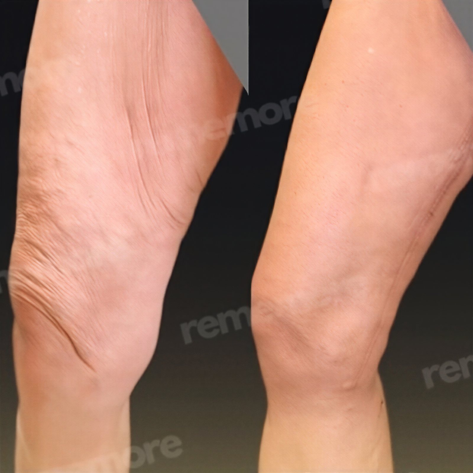 Resultados de lifting de muslos antes y después en Memorial Bahçelievler Hospital, muslo más liso
