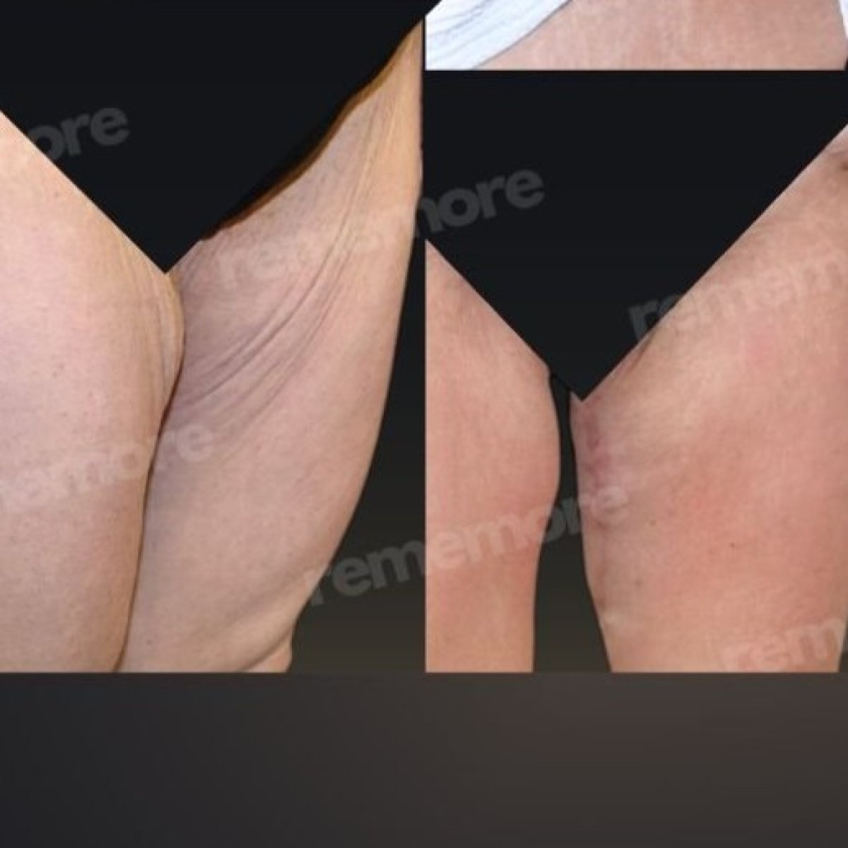 Before and after thigh lift results at Memorial Bahçelievler Hospital, improved thigh contour