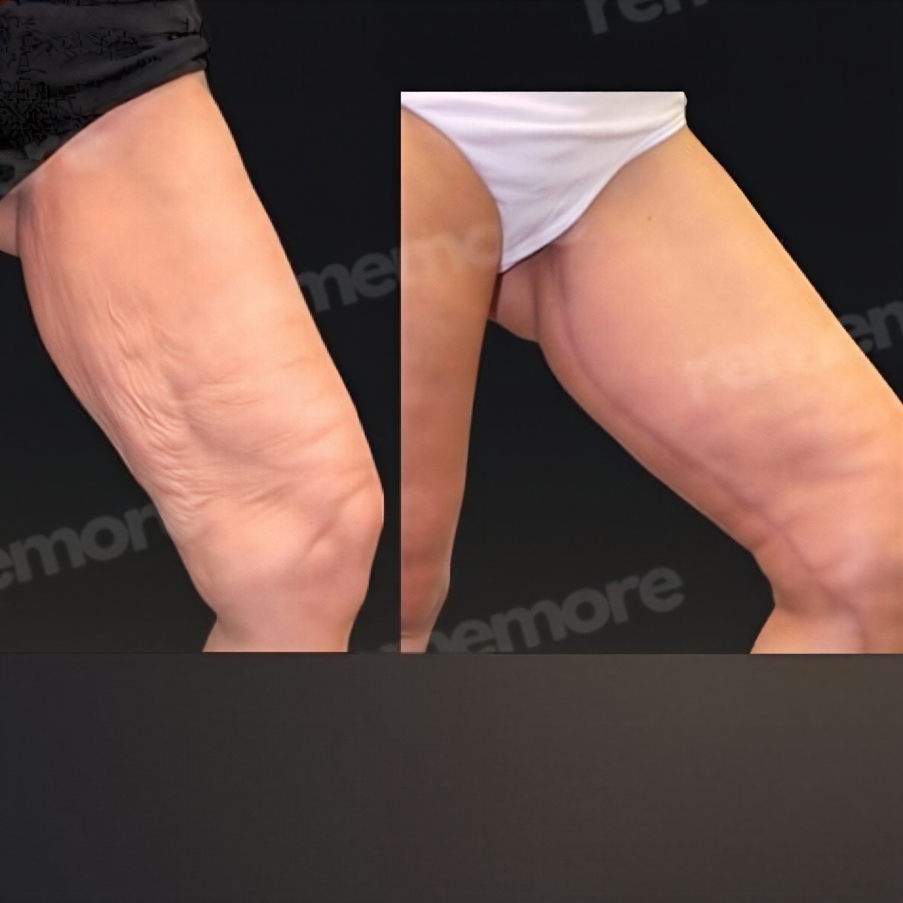 Resultados de lifting de muslos antes y después en Memorial Bahçelievler Hospital, muslo más liso