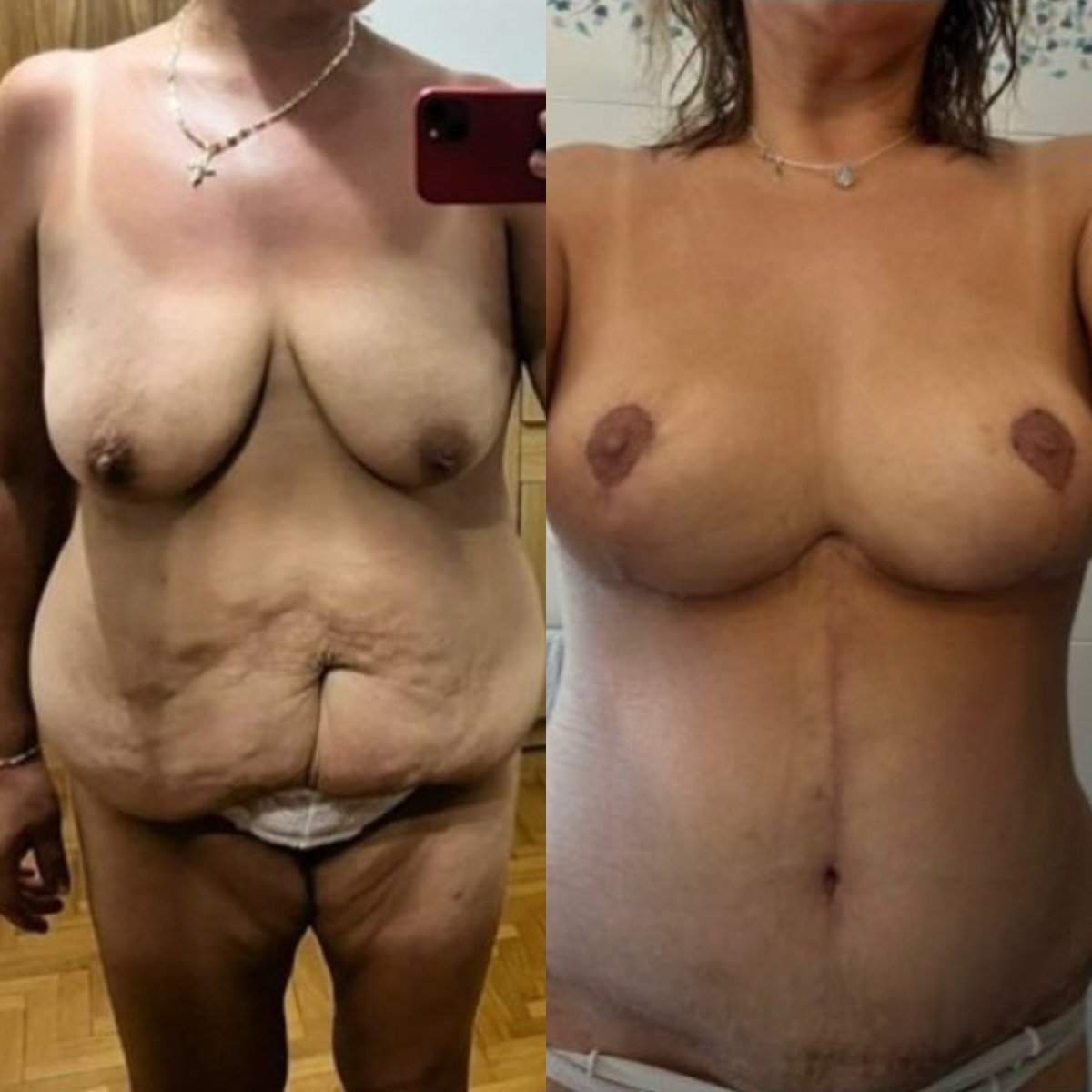 Before and after liposuction results at Memorial Ankara Hospital, improved body contour visible