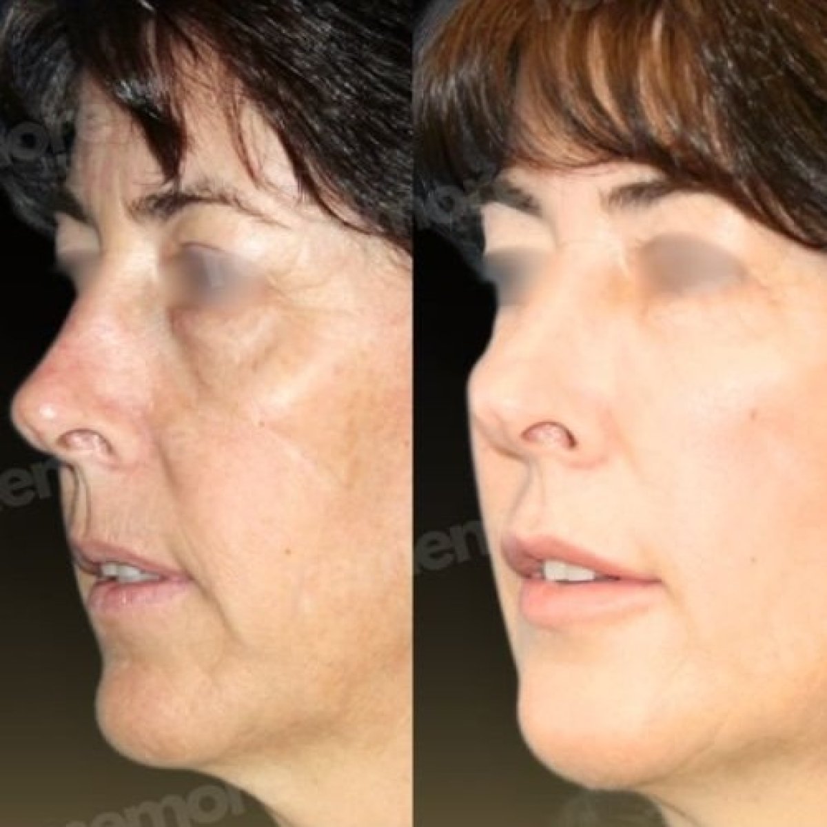 Before and after lipofilling results at Memorial Göztepe Hospital, facial volume restoration