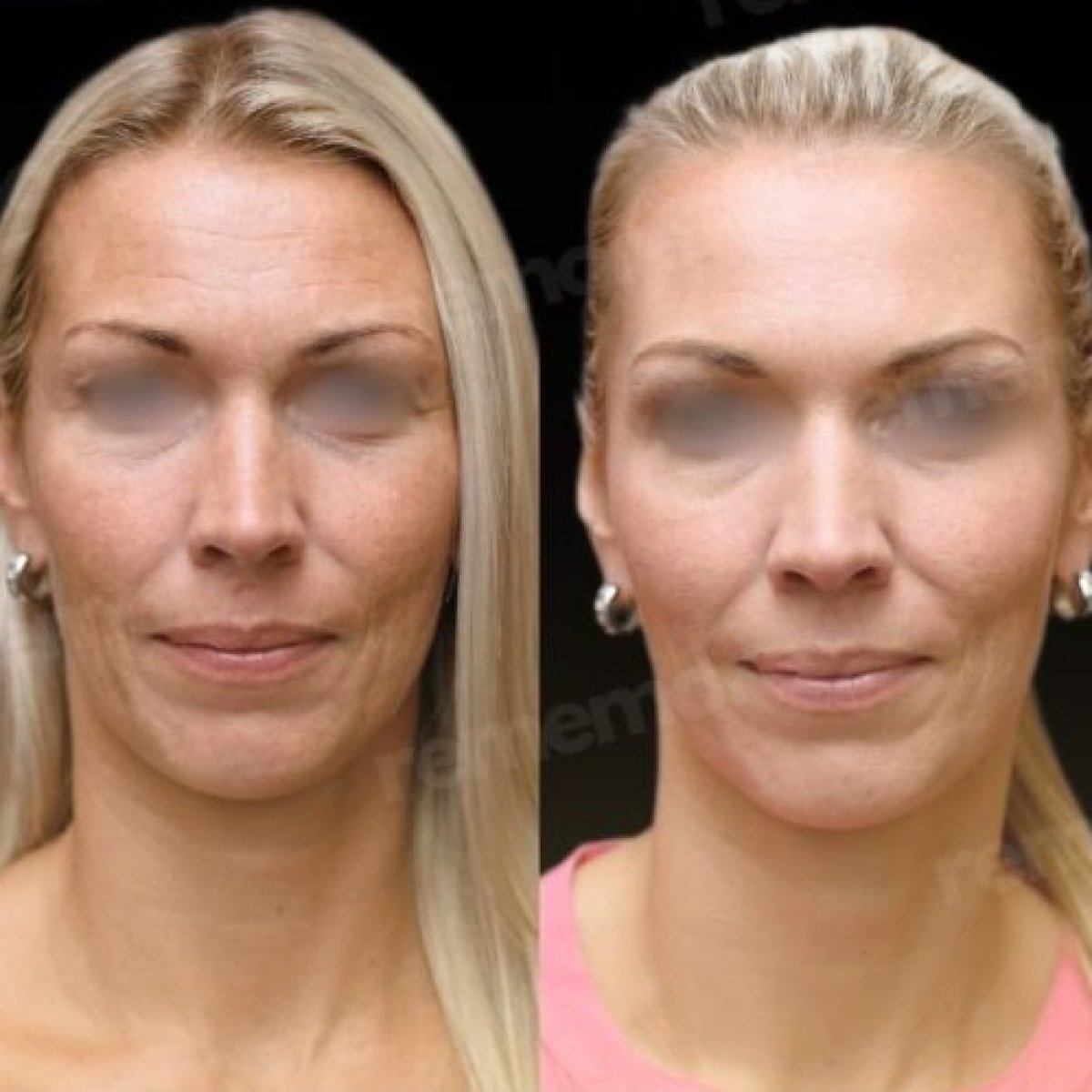 Before and after lipofilling results at Memorial Göztepe Hospital, facial volume restoration