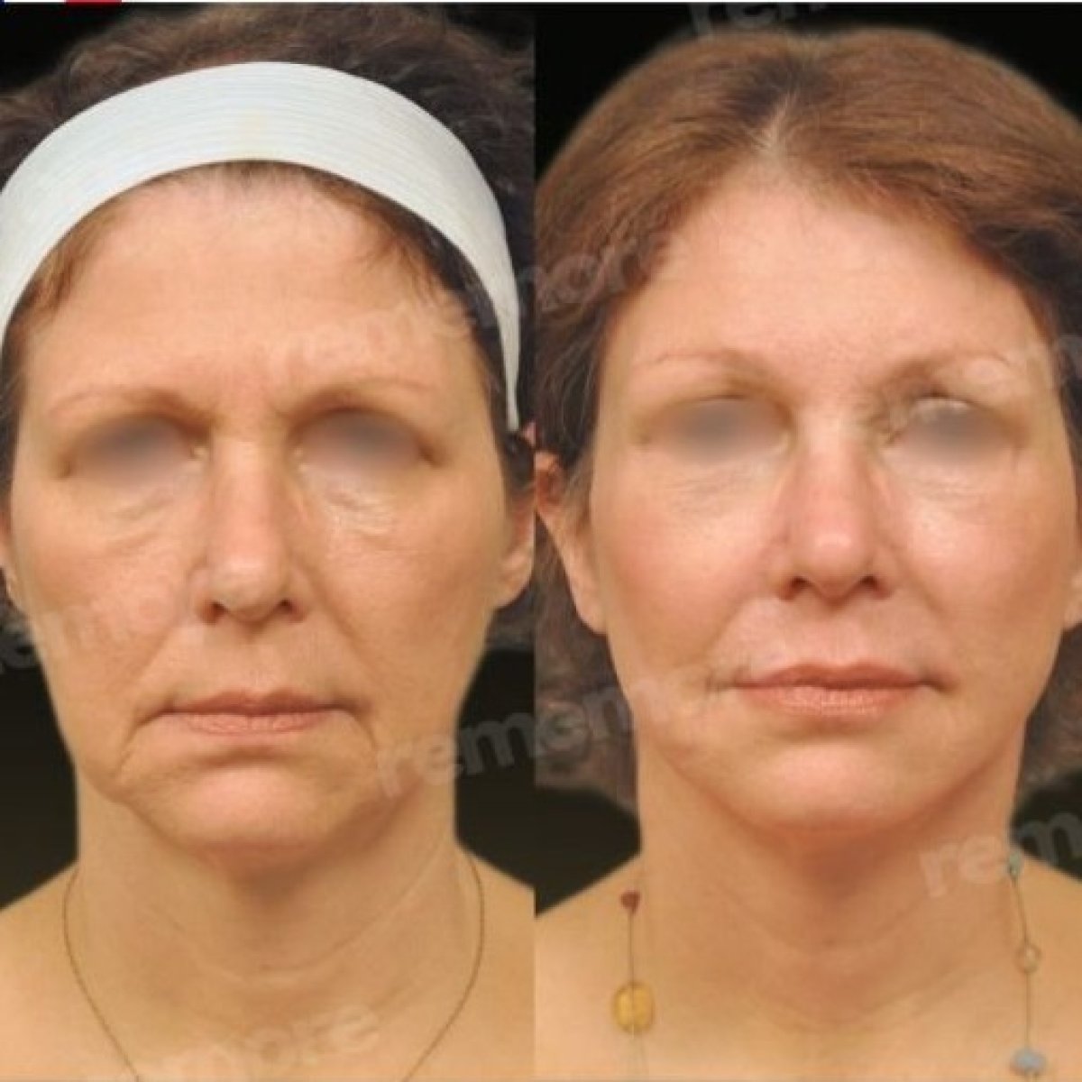 Resultados de lipofilling antes y después en Memorial Göztepe Hospital, rejuvenecimiento facial visible