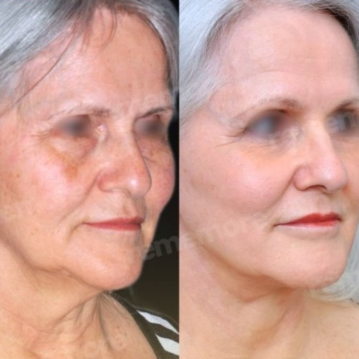 Resultados de lipofilling antes y después en Memorial Göztepe Hospital, rejuvenecimiento facial