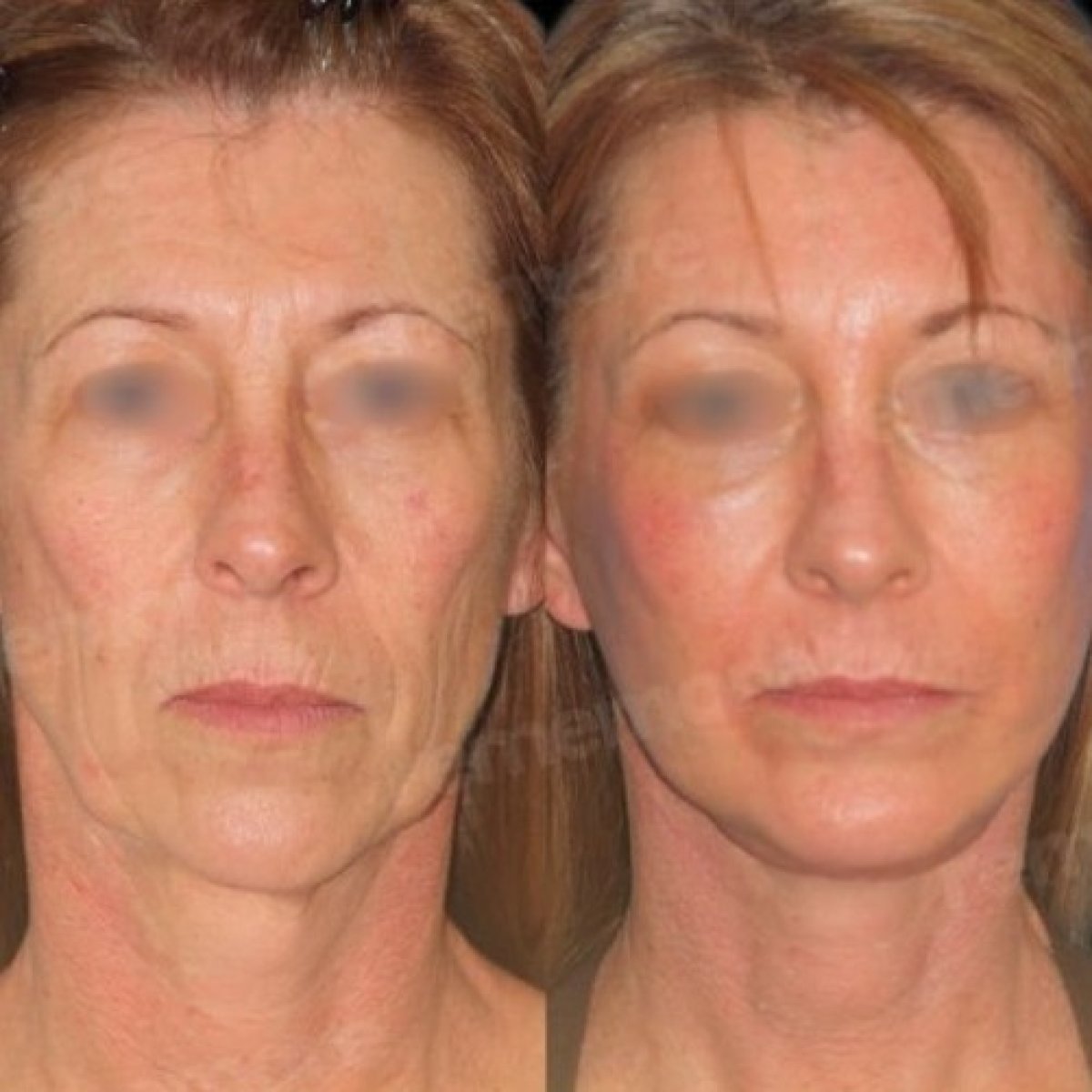 Resultados de lipofilling antes y después en Memorial Göztepe Hospital, rejuvenecimiento facial visible