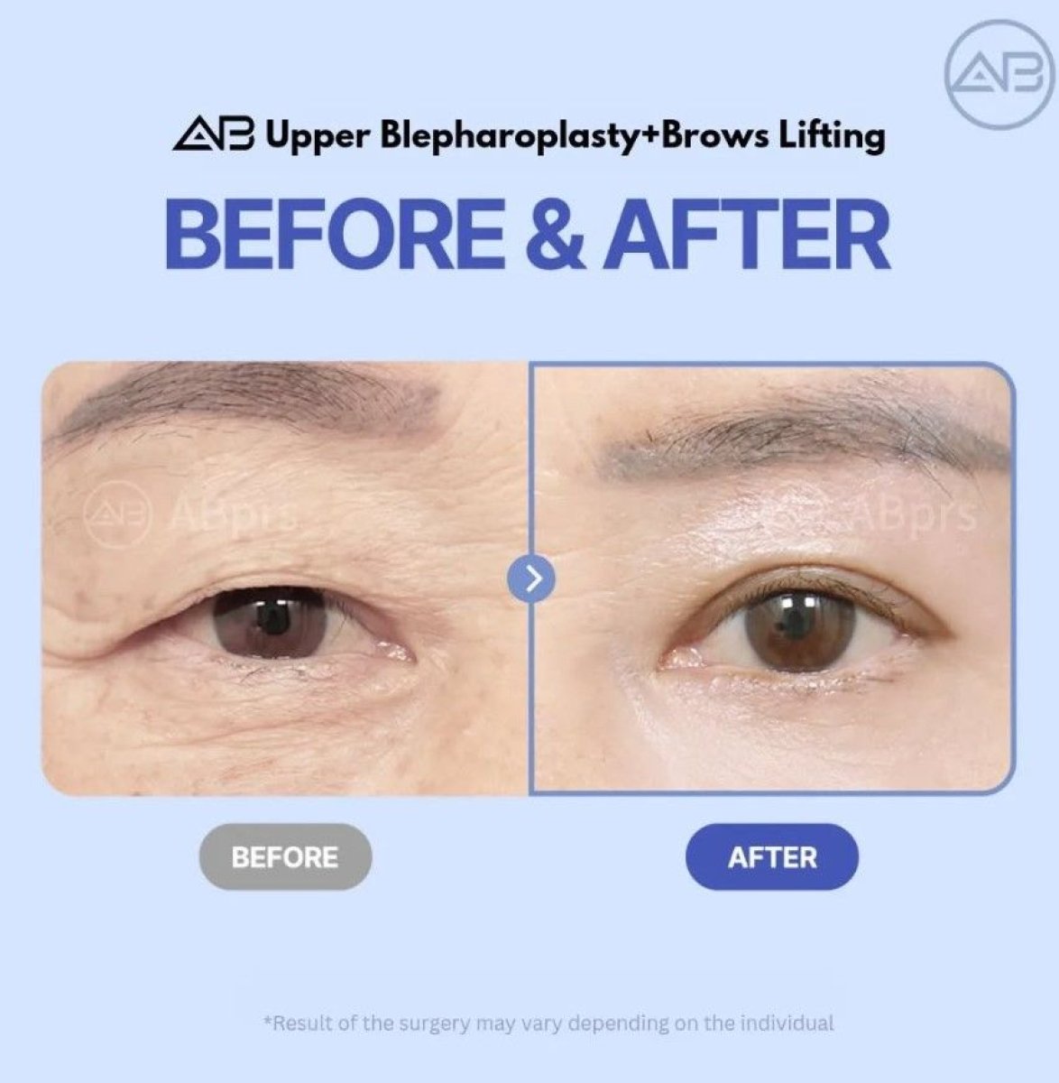 Résultats avant/après blépharoplastie supérieure et lifting des sourcils chez AB Plastic Surgery