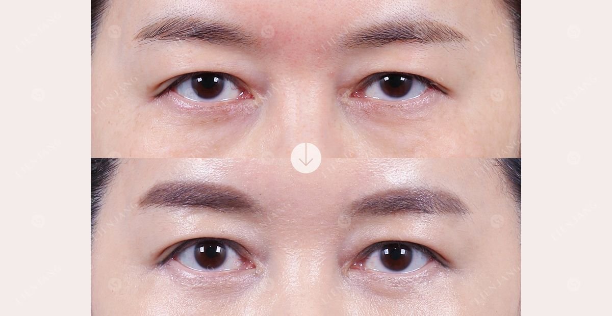 Before and after forehead lift results – smoother brow and lifted eyelids visible