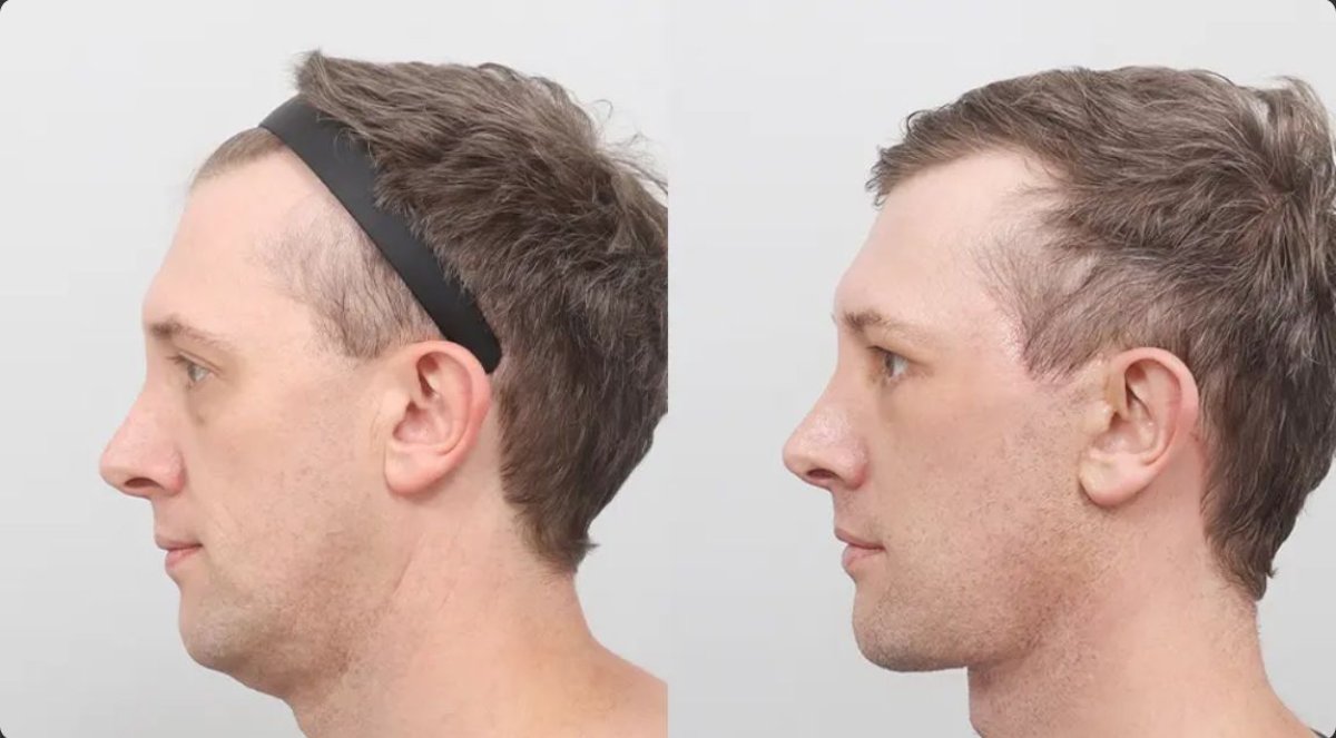 Before and after hair transplant results at AB Plastic Surgery, improved hairline in male patient