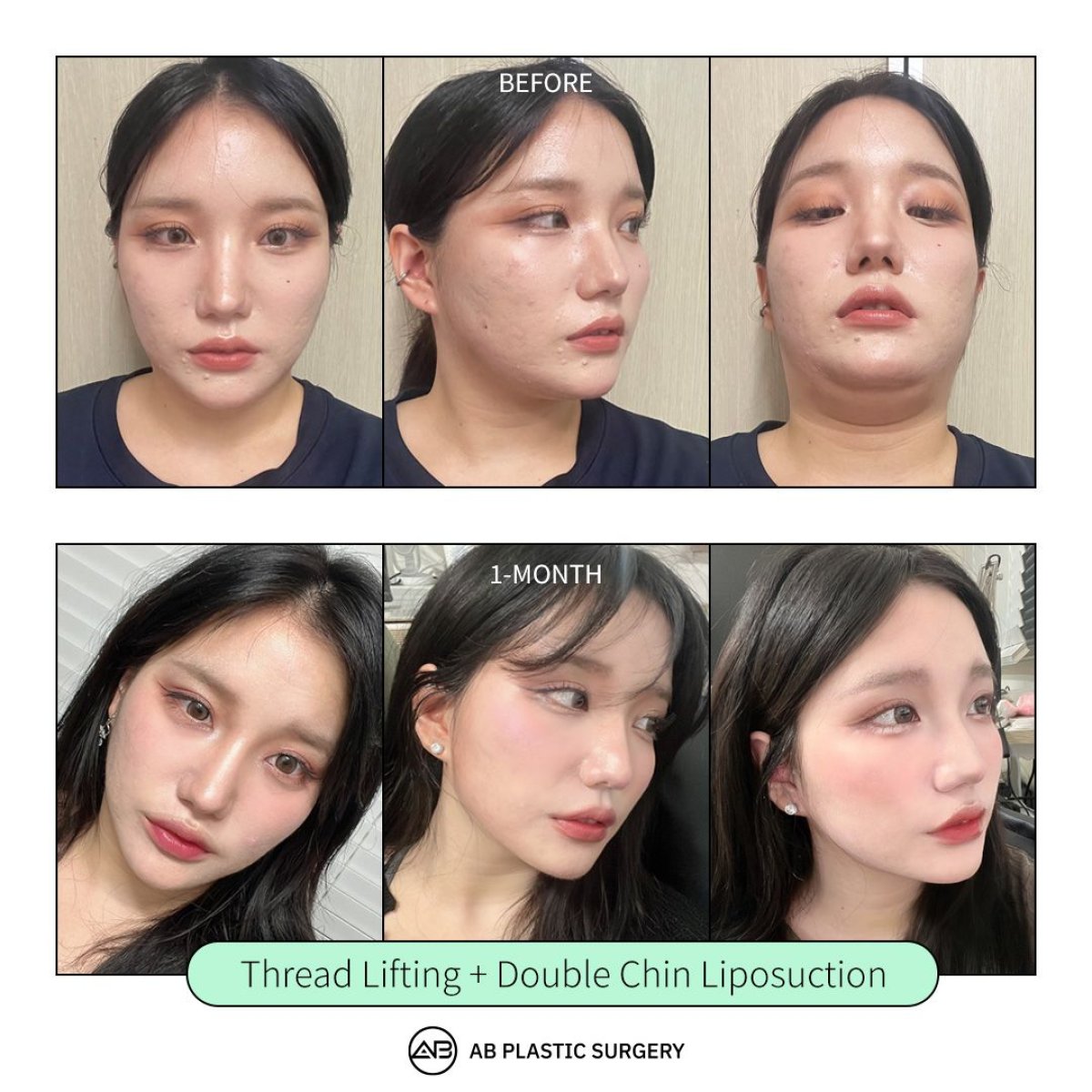 Before and after chin liposuction and thread lifting results at AB Plastic Surgery clinic