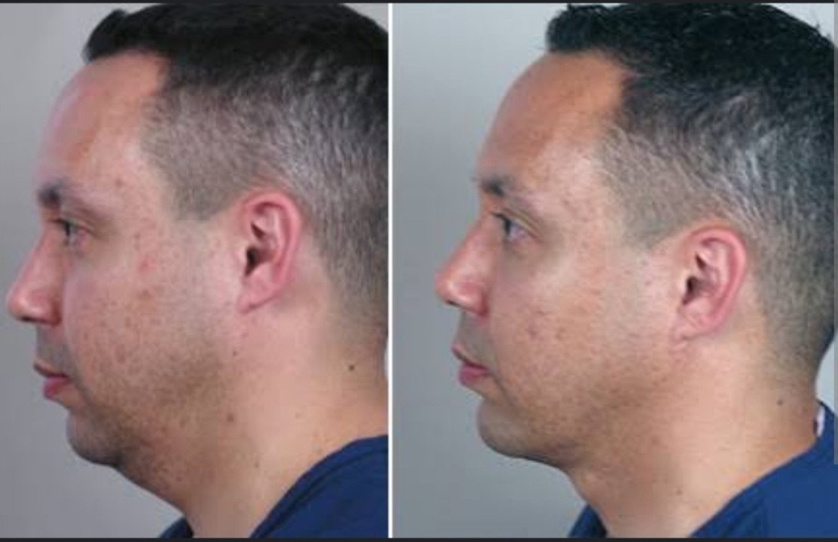 Before and after double chin removal at ID Clinic Bangkok, visible jawline contour improvement result