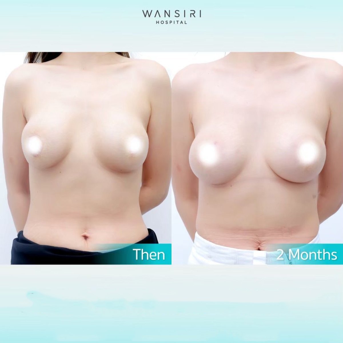 Resultados antes y después de aumento de senos en Wansiri Hospital, 2 meses tras cirugía