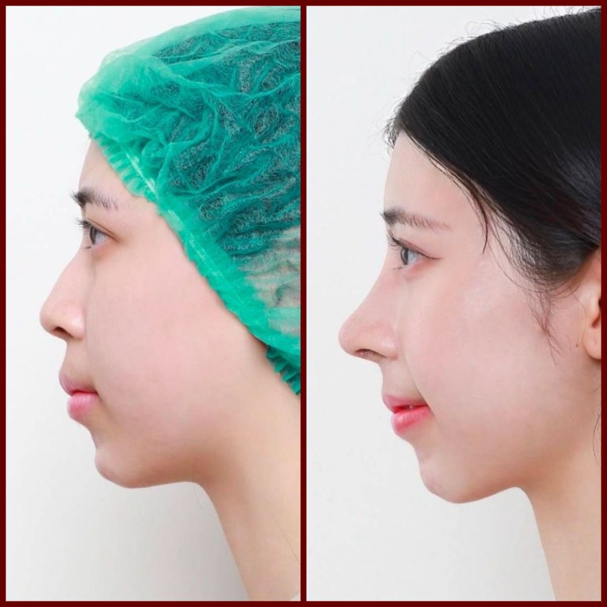 Resultado de rinoplastia antes y después en DGB Clinic, perfil nasal natural