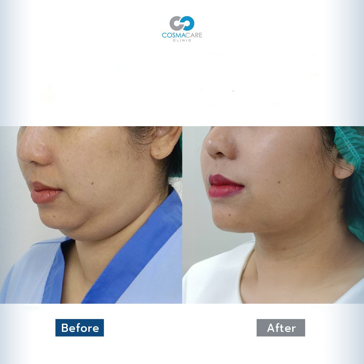 نتائج شفط الدهون قبل وبعد في Cosmacare Clinic، تحسين تحديد الذقن والفك