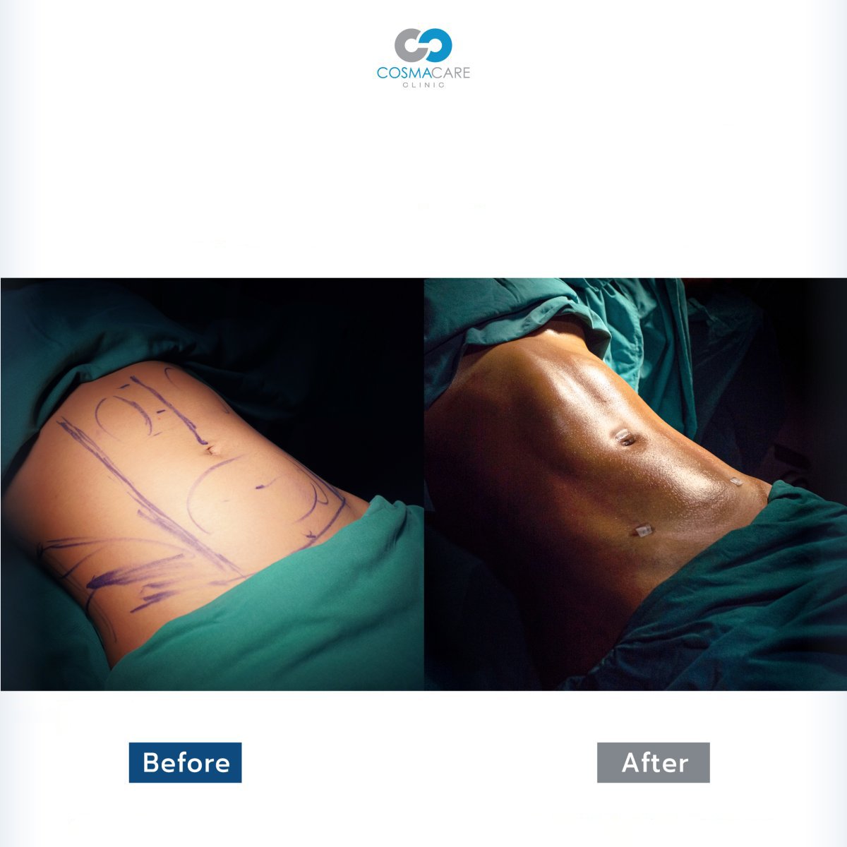 Résultats avant et après liposuccion à Cosmacare Clinic Center, abdomen