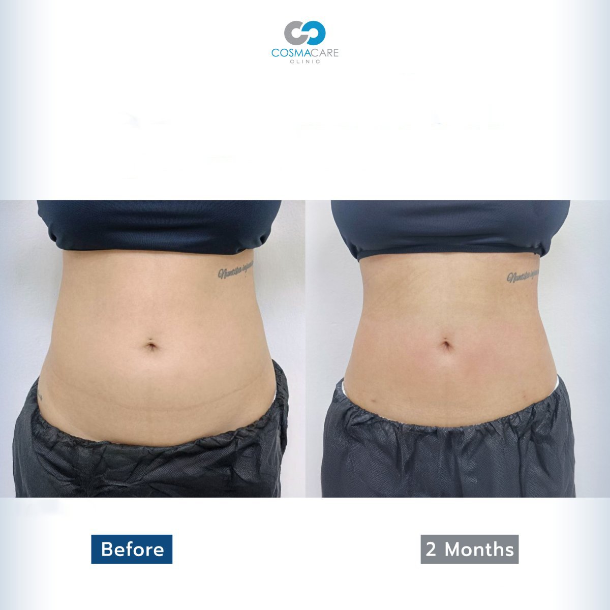 Before and after liposuction result at Cosmacare Clinic, visible waist contour improvement