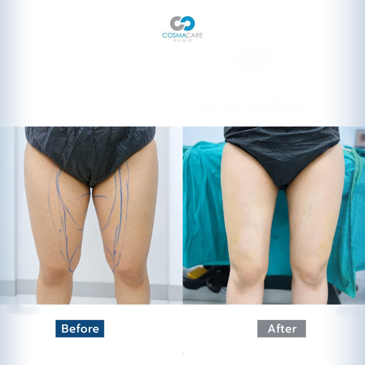 Before and after liposuction results on thighs at Cosmacare Clinic Center for Aesthetic Medicine