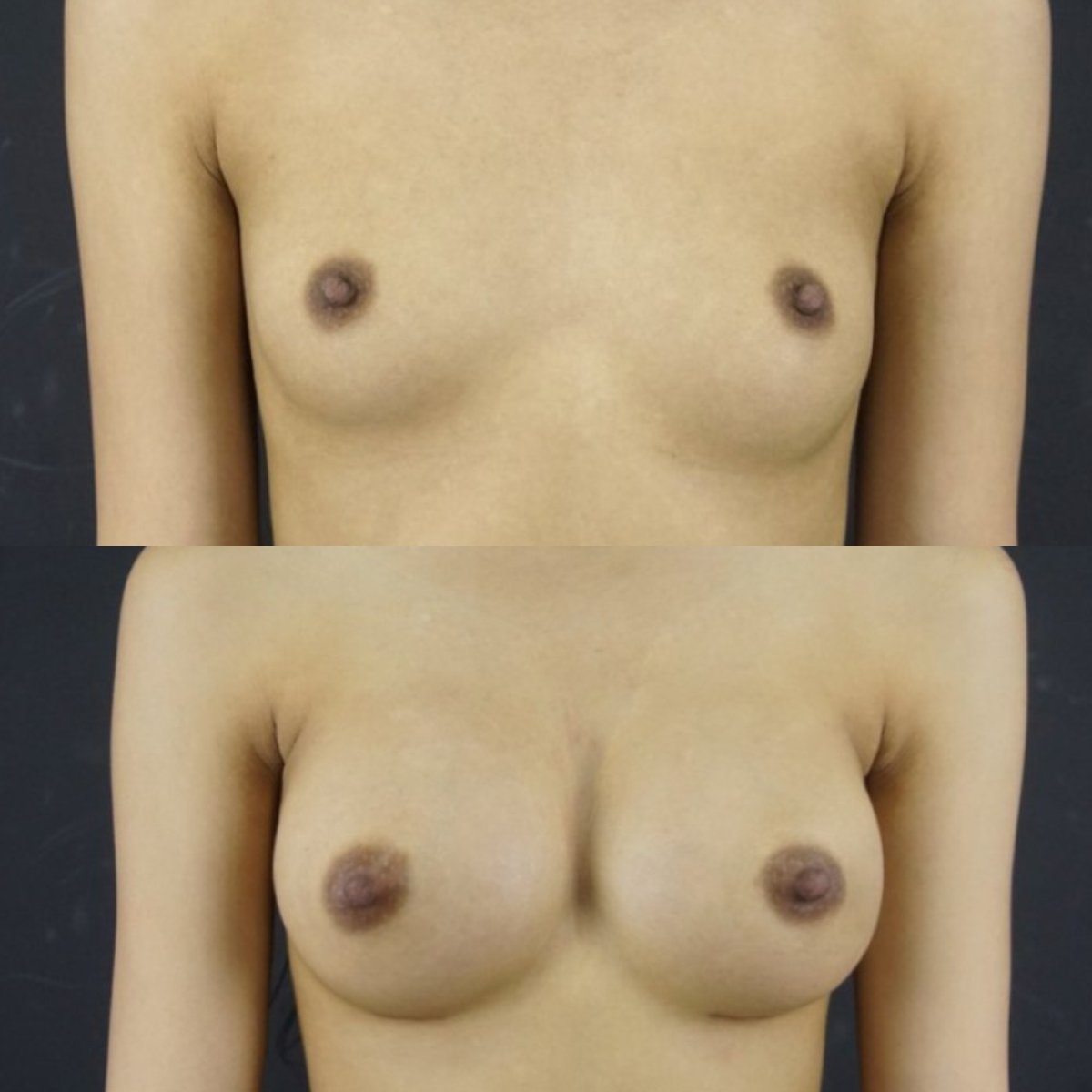 Résultats avant et après augmentation mammaire à Cosmacare Clinic Center for Aesthetic Medicine