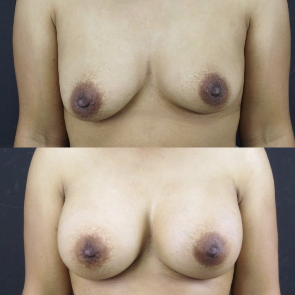Résultats avant et après augmentation mammaire à Cosmacare Clinic Center for Aesthetic Medicine
