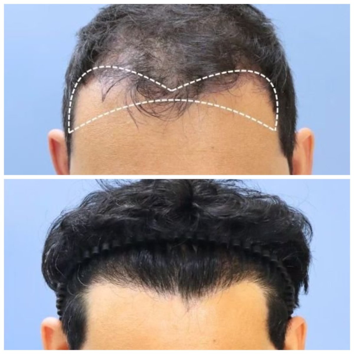 نتائج زراعة الشعر قبل وبعد في مستشفى إنترارات – استعادة خط الشعر الطبيعي